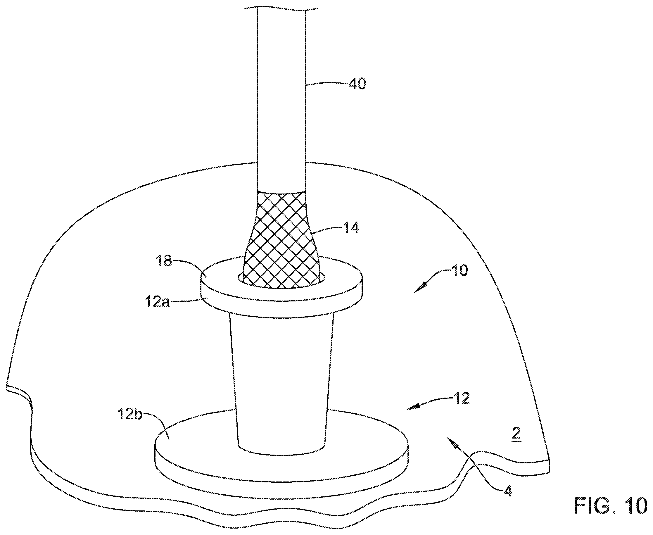 Patent US12508012 Figure 10 – Retrievable access valve
