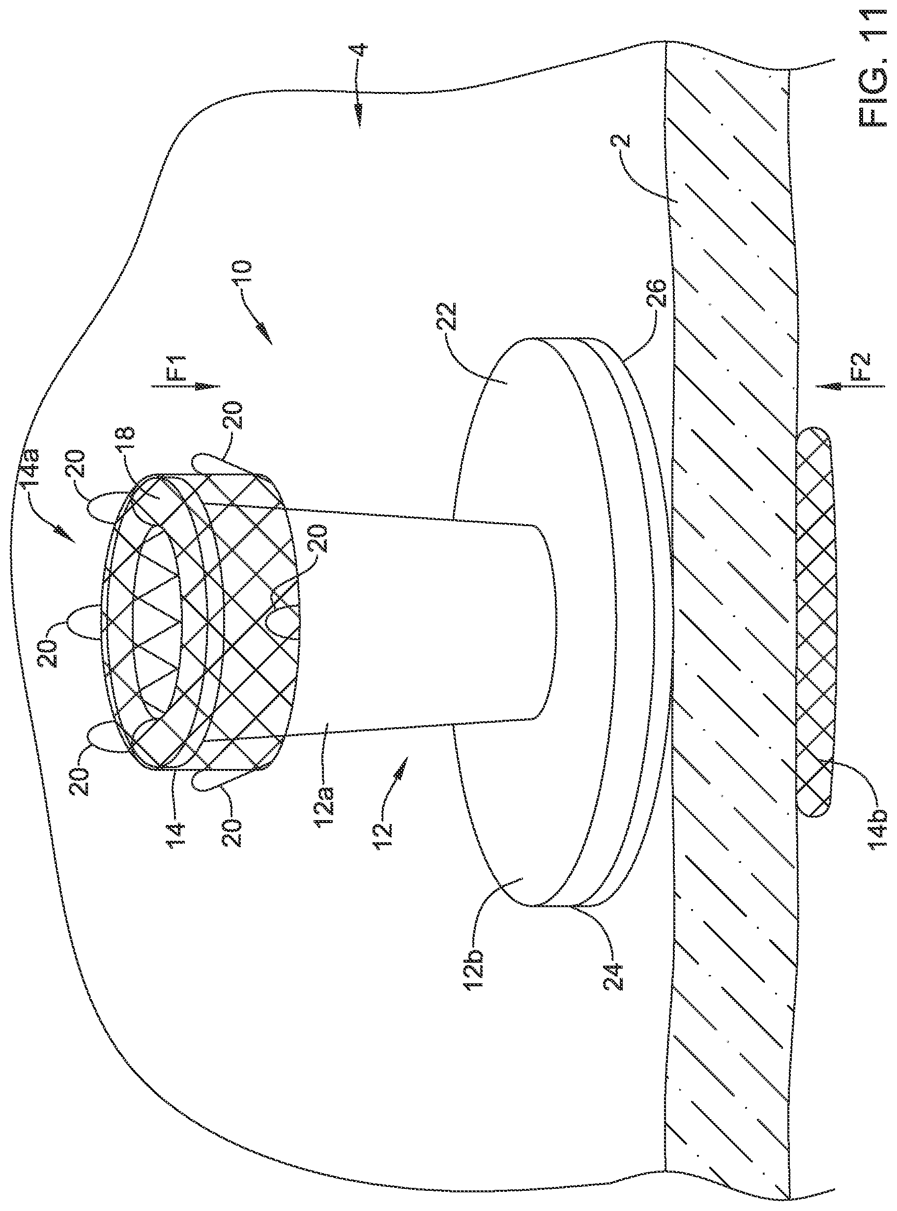 Patent US12508012 Figure 11 – Retrievable access valve