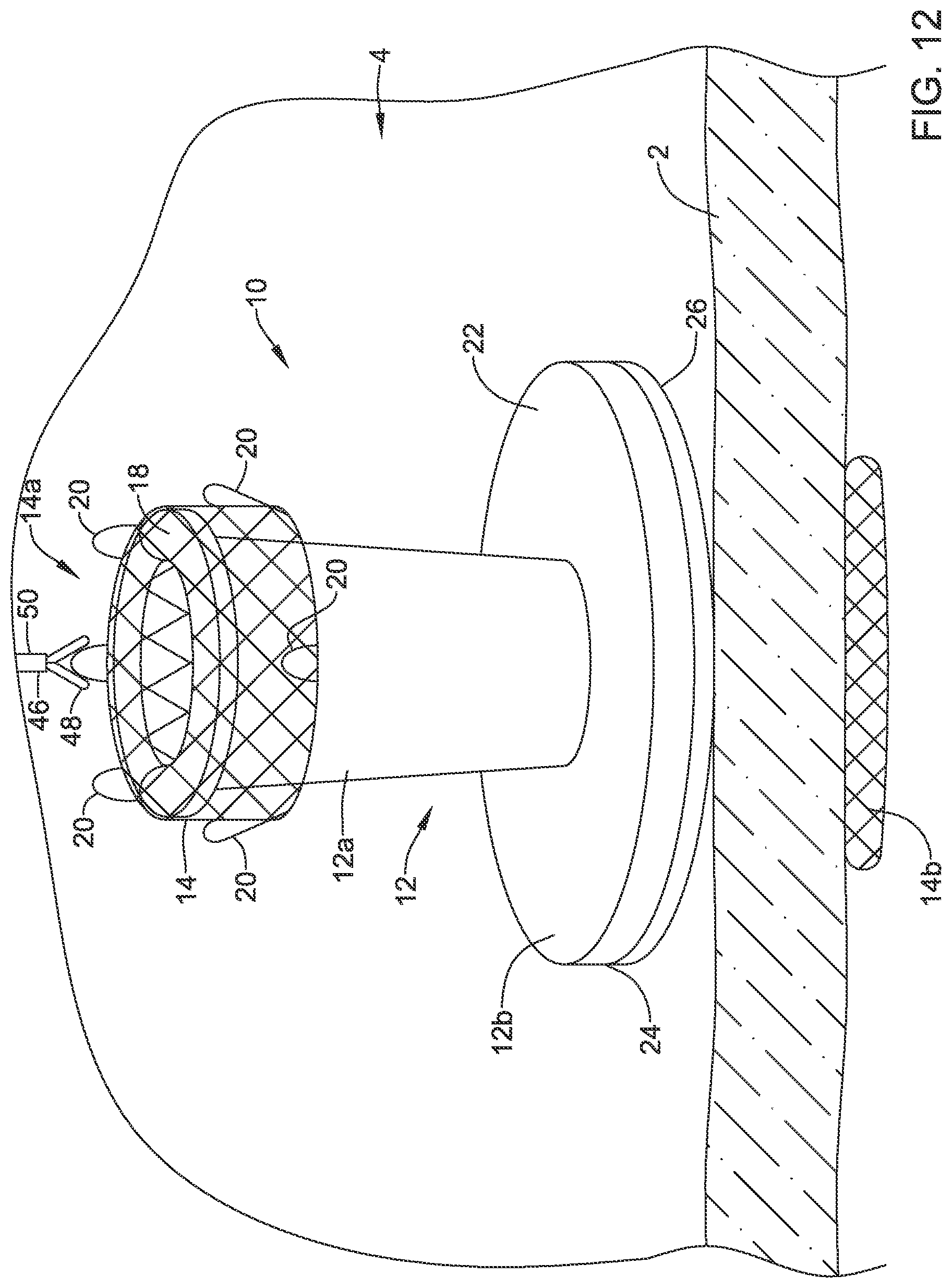 Patent US12508012 Figure 12 – Retrievable access valve