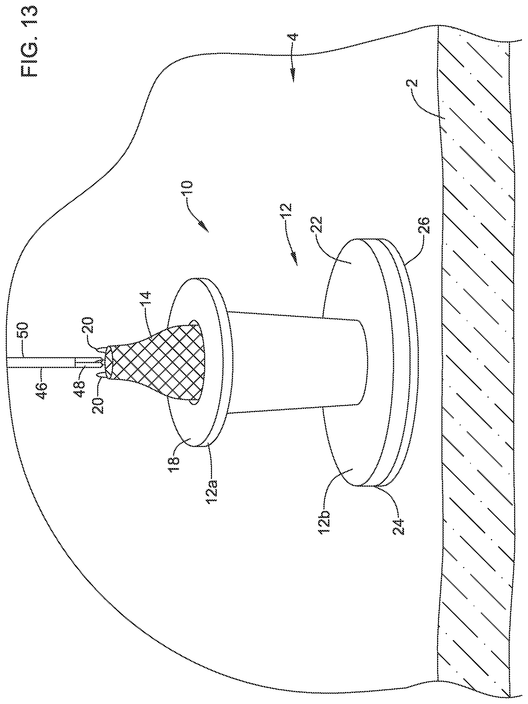 Patent US12508012 Figure 13 – Retrievable access valve