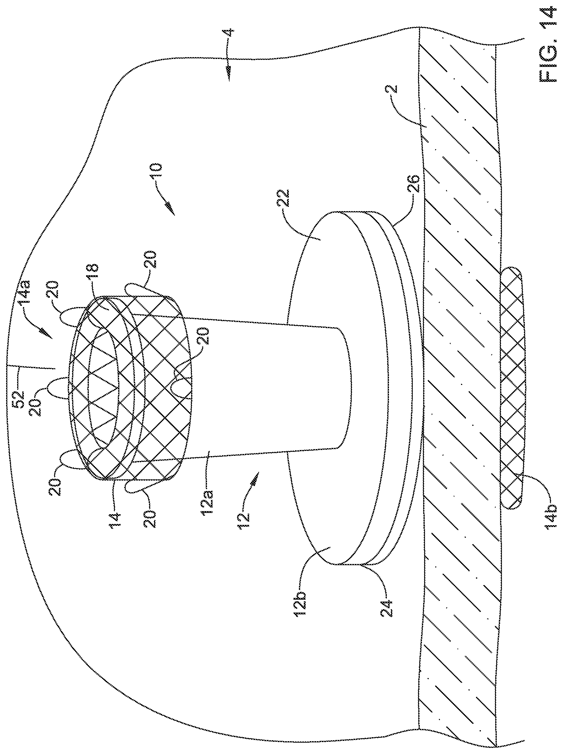 Patent US12508012 Figure 14 – Retrievable access valve