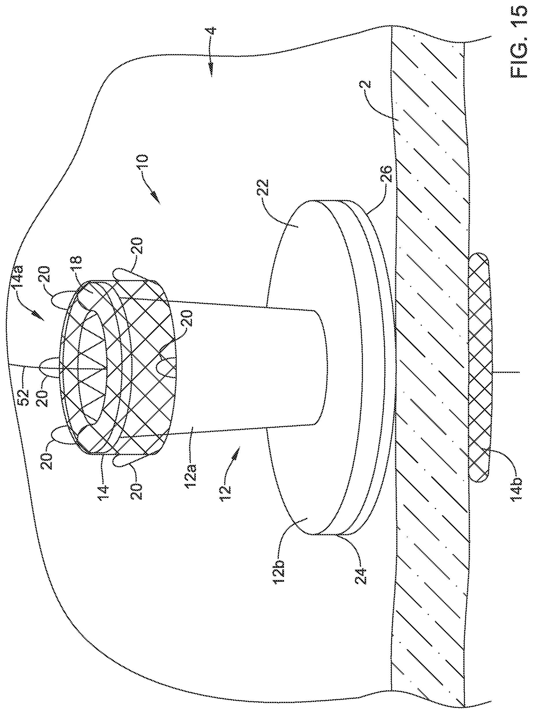 Patent US12508012 Figure 15 – Retrievable access valve