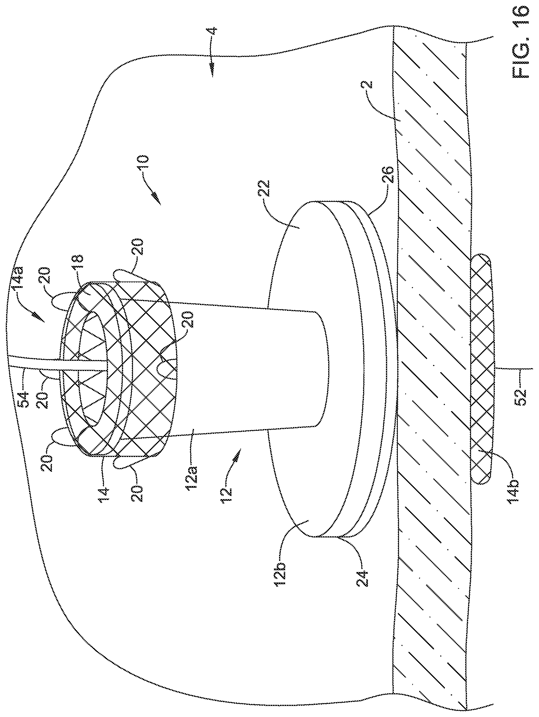 Patent US12508012 Figure 16 – Retrievable access valve