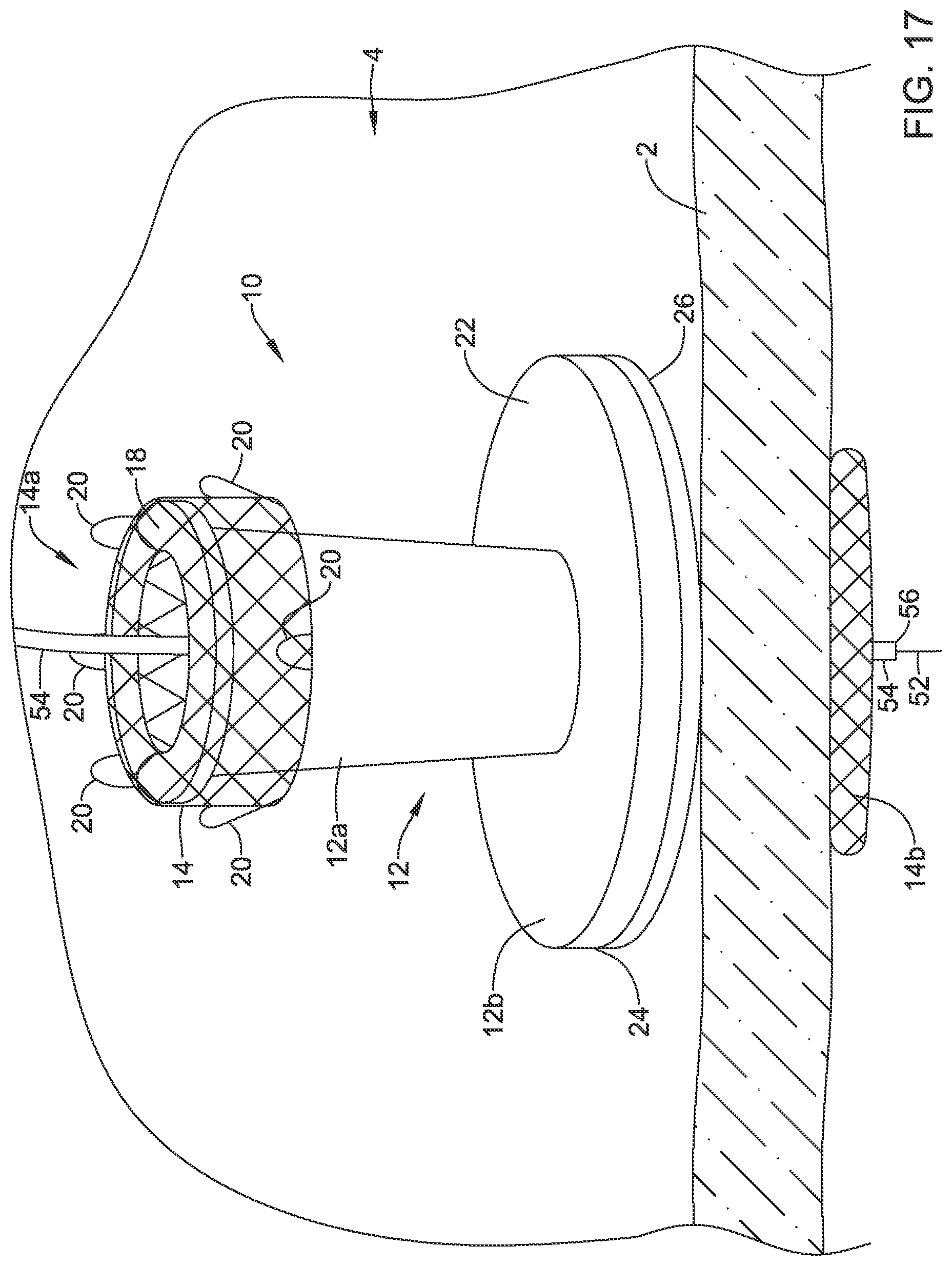 Patent US12508012 Figure 17 – Retrievable access valve