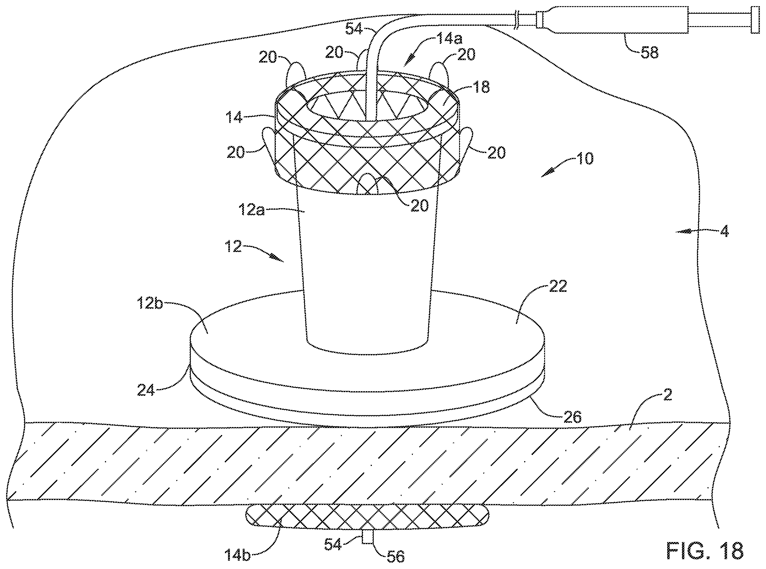 Patent US12508012 Figure 18 – Retrievable access valve