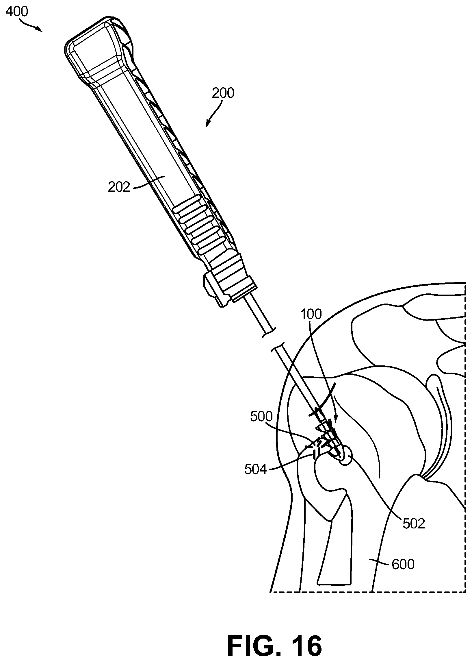 Patent US12508014 Figure 10 – Anchors and anchoring systems