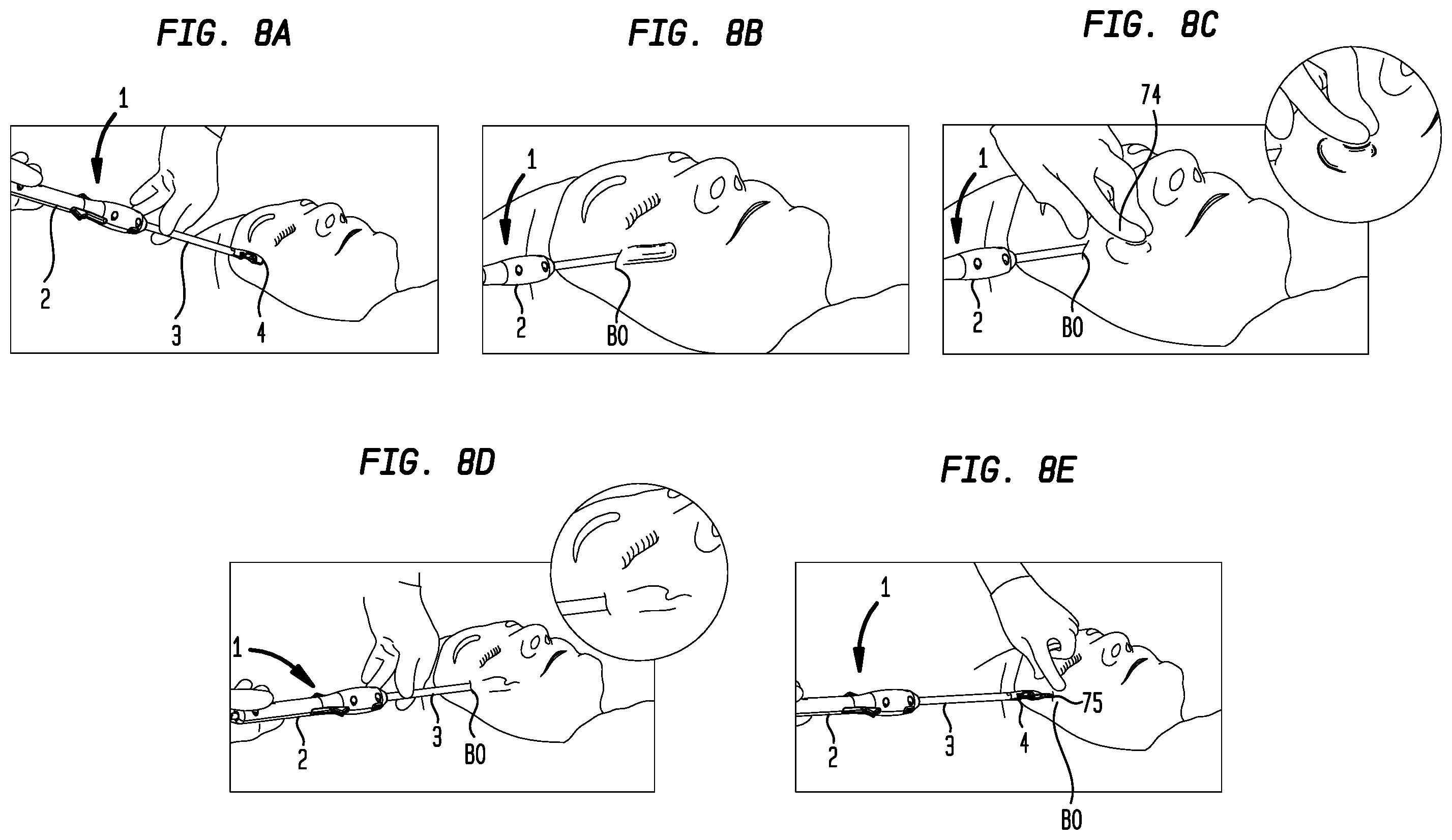 Patent US12508015 Figure 10 – Suturing apparatus needle drive