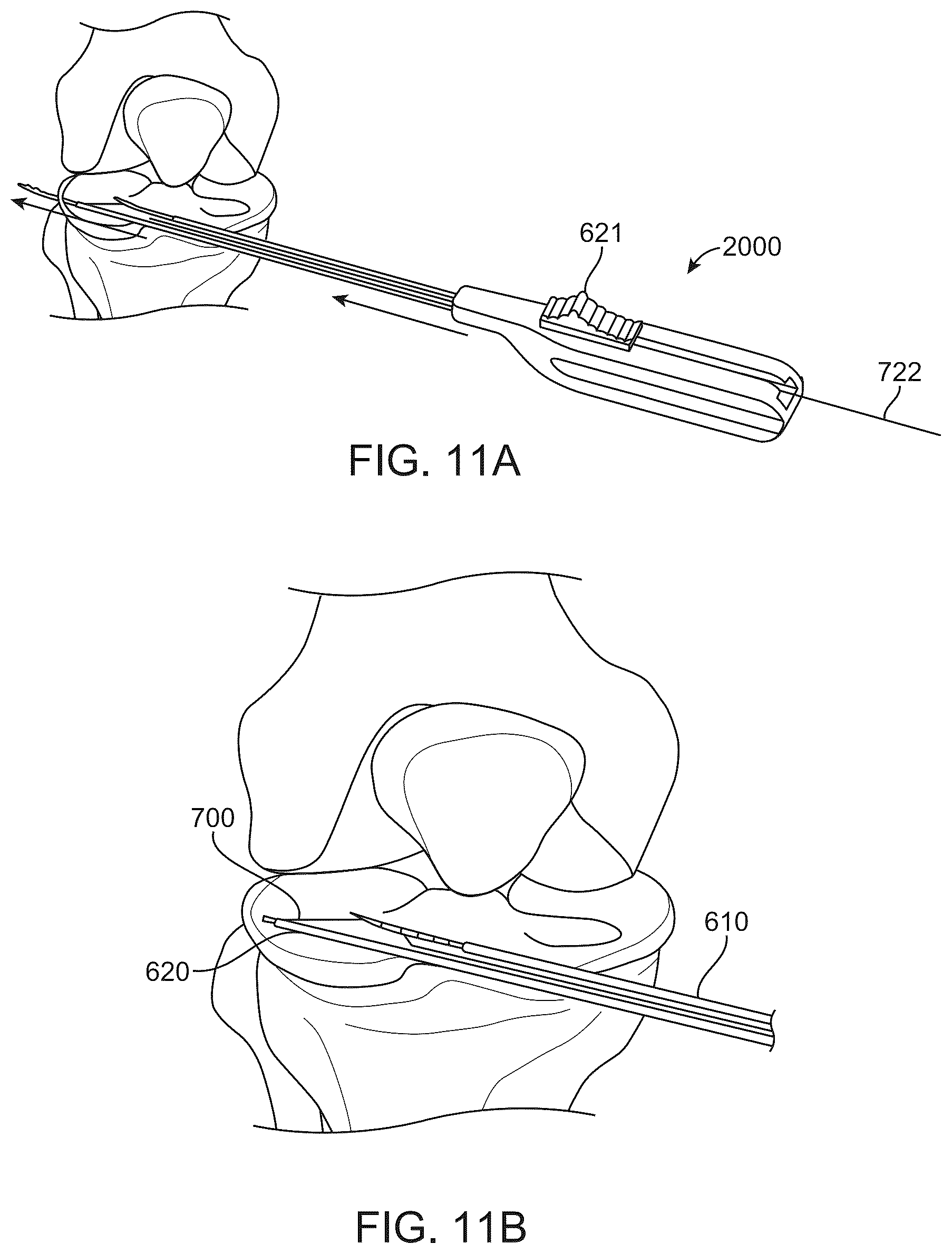 Patent US12508016 Figure 13 – All-suture anchor
