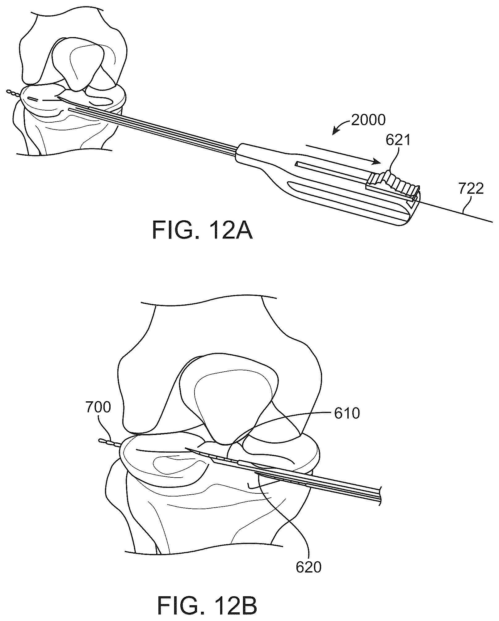Patent US12508016 Figure 14 – All-suture anchor