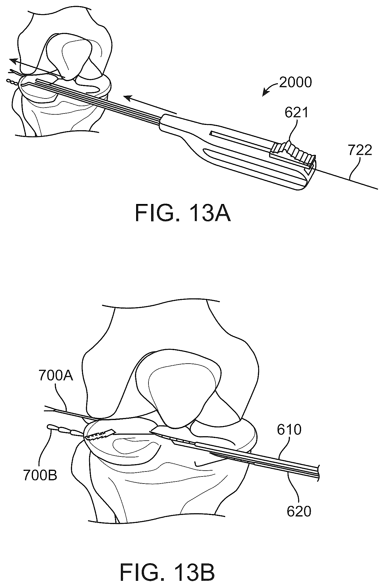 Patent US12508016 Figure 15 – All-suture anchor