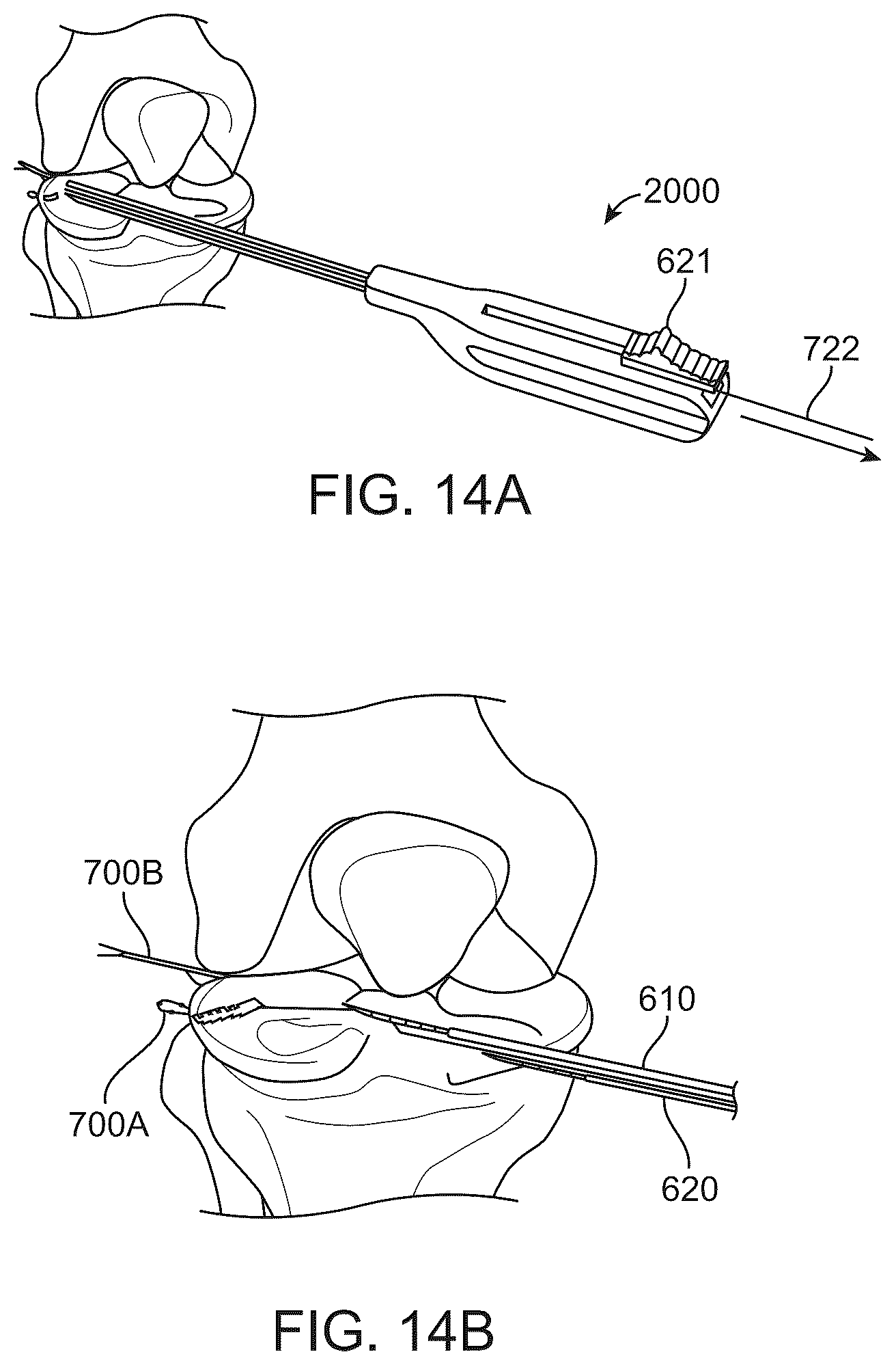 Patent US12508016 Figure 16 – All-suture anchor