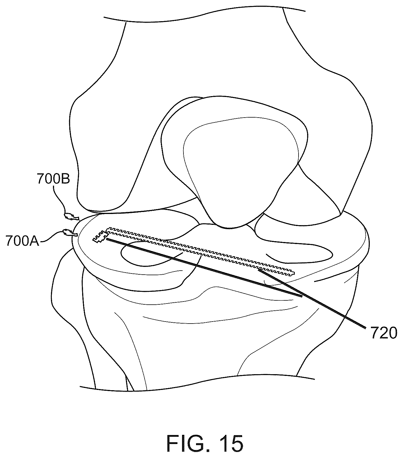 Patent US12508016 Figure 17 – All-suture anchor