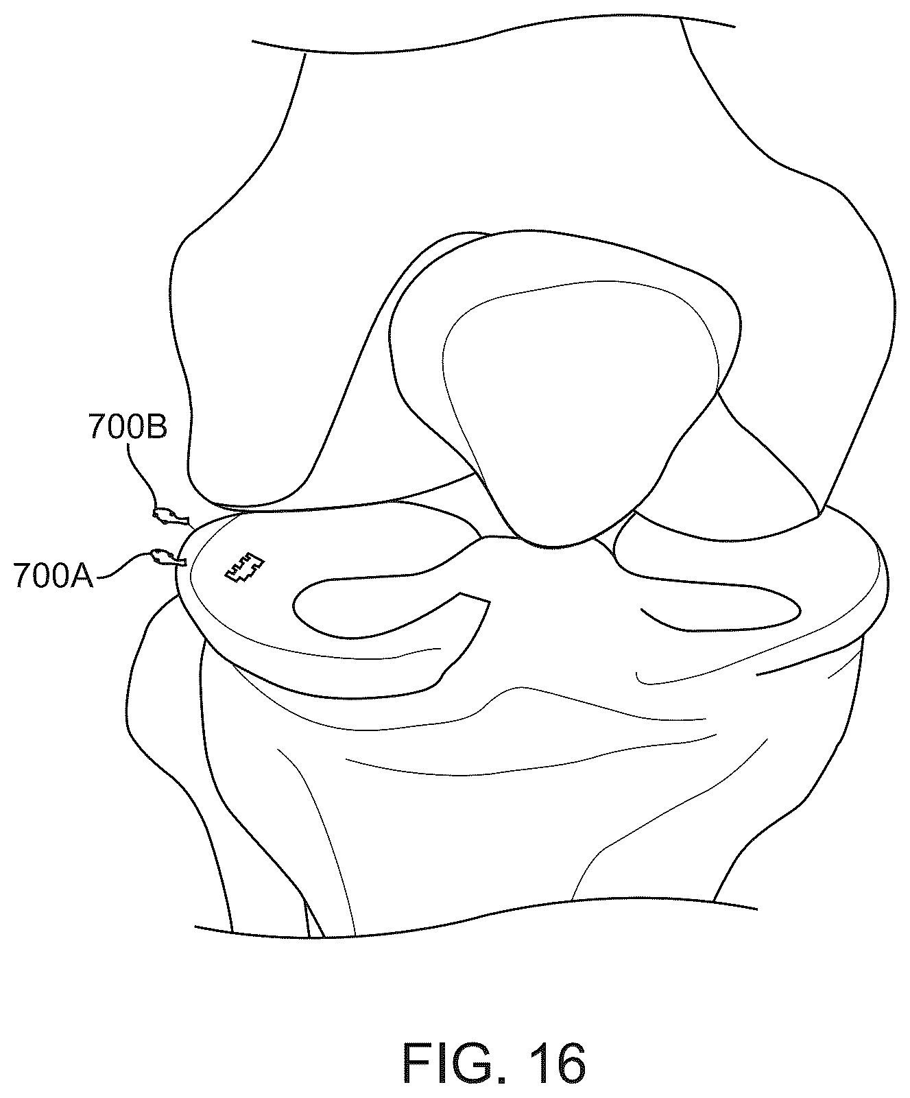 Patent US12508016 Figure 18 – All-suture anchor