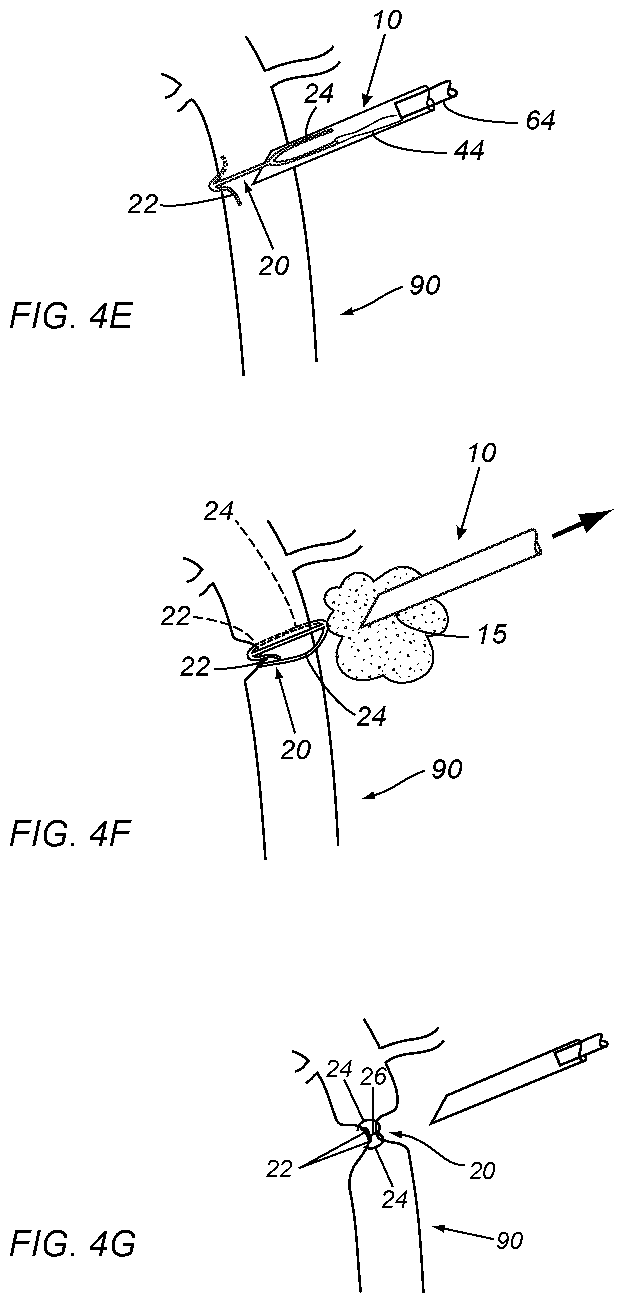 Patent US12508030 Figure 7 – Apparatus and methods for closing vessels