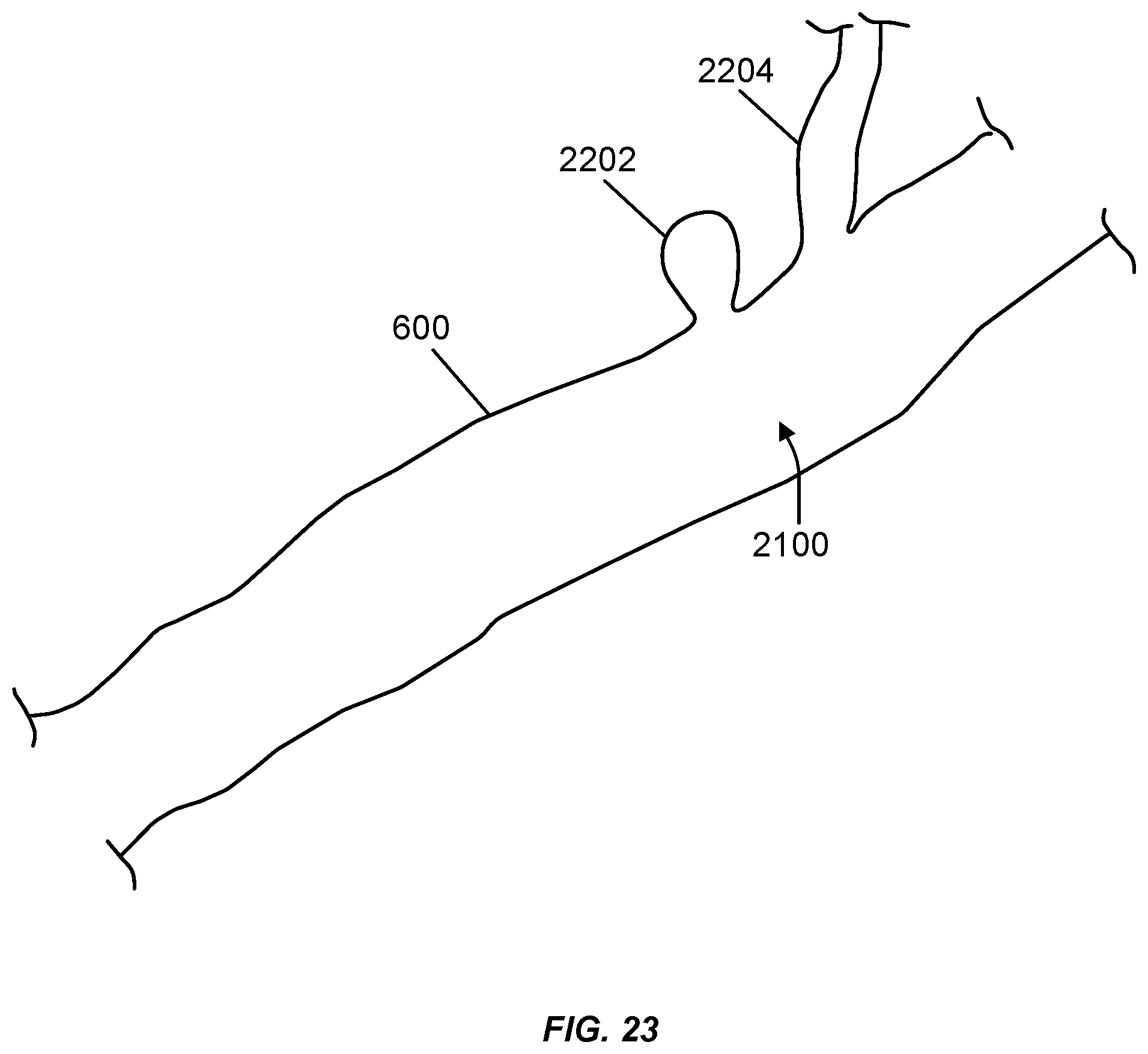 Patent US12508031 Figure 16 – Neurovascular flow diverter and delivery systems