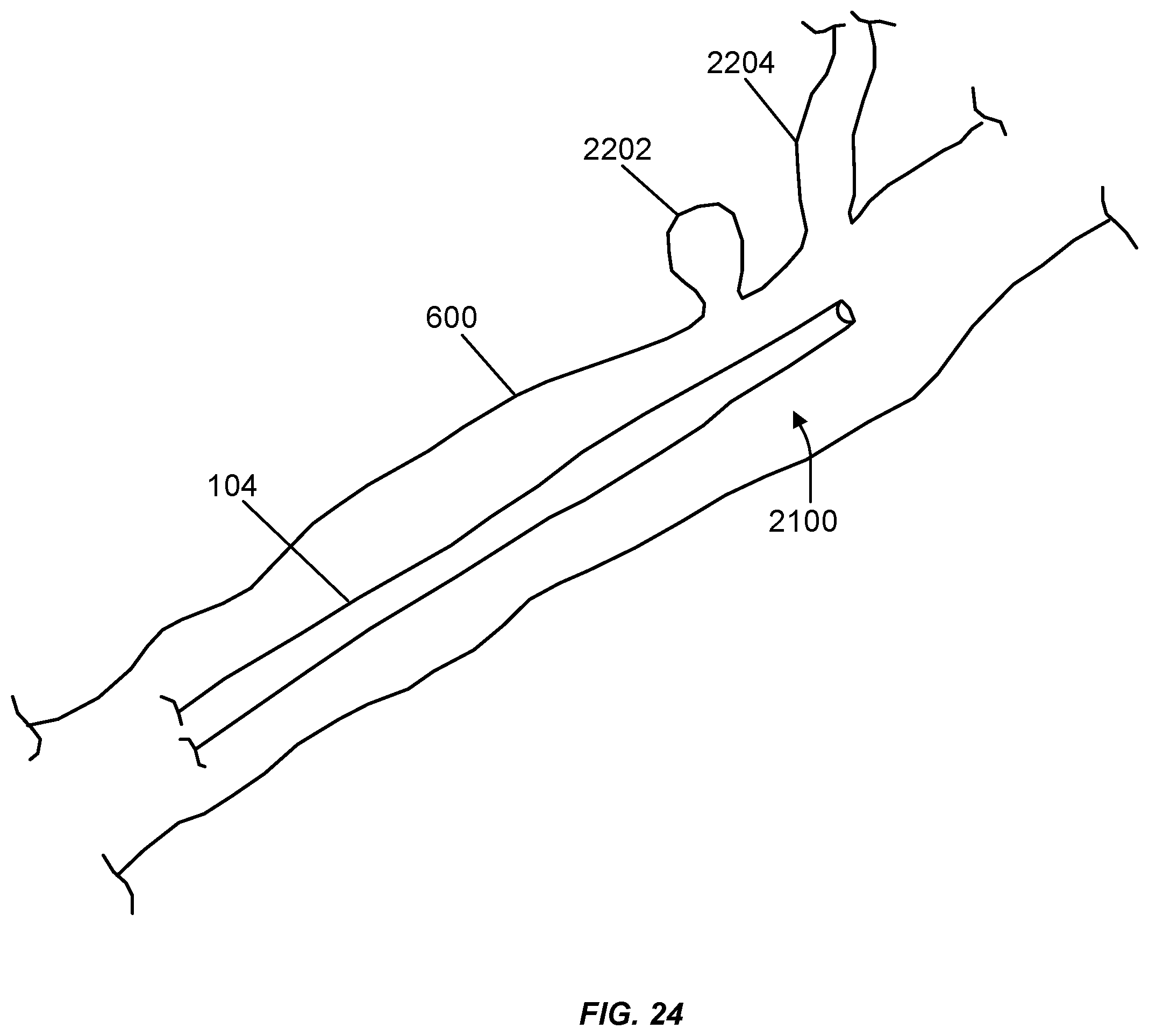 Patent US12508031 Figure 17 – Neurovascular flow diverter and delivery systems