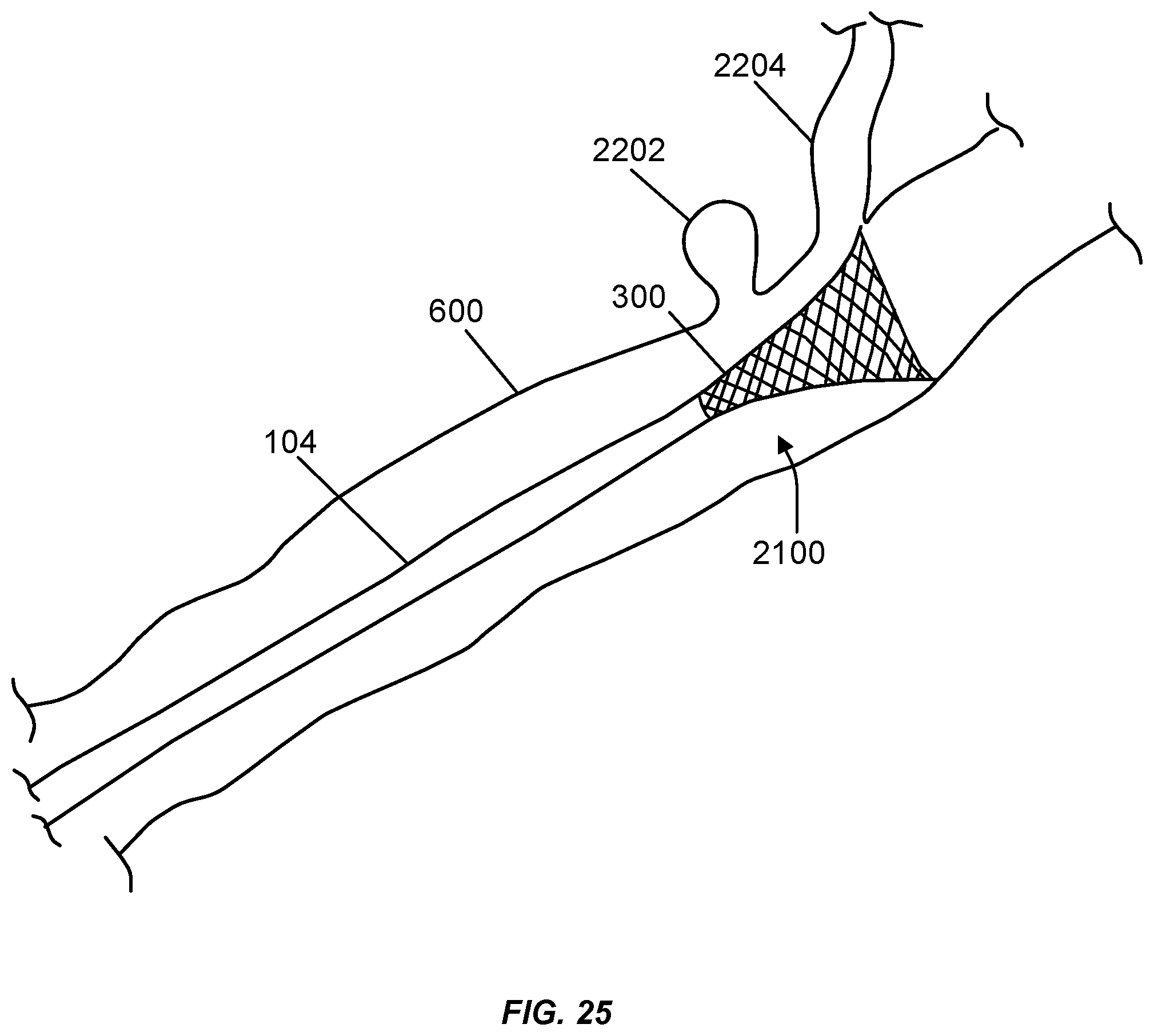 Patent US12508031 Figure 18 – Neurovascular flow diverter and delivery systems