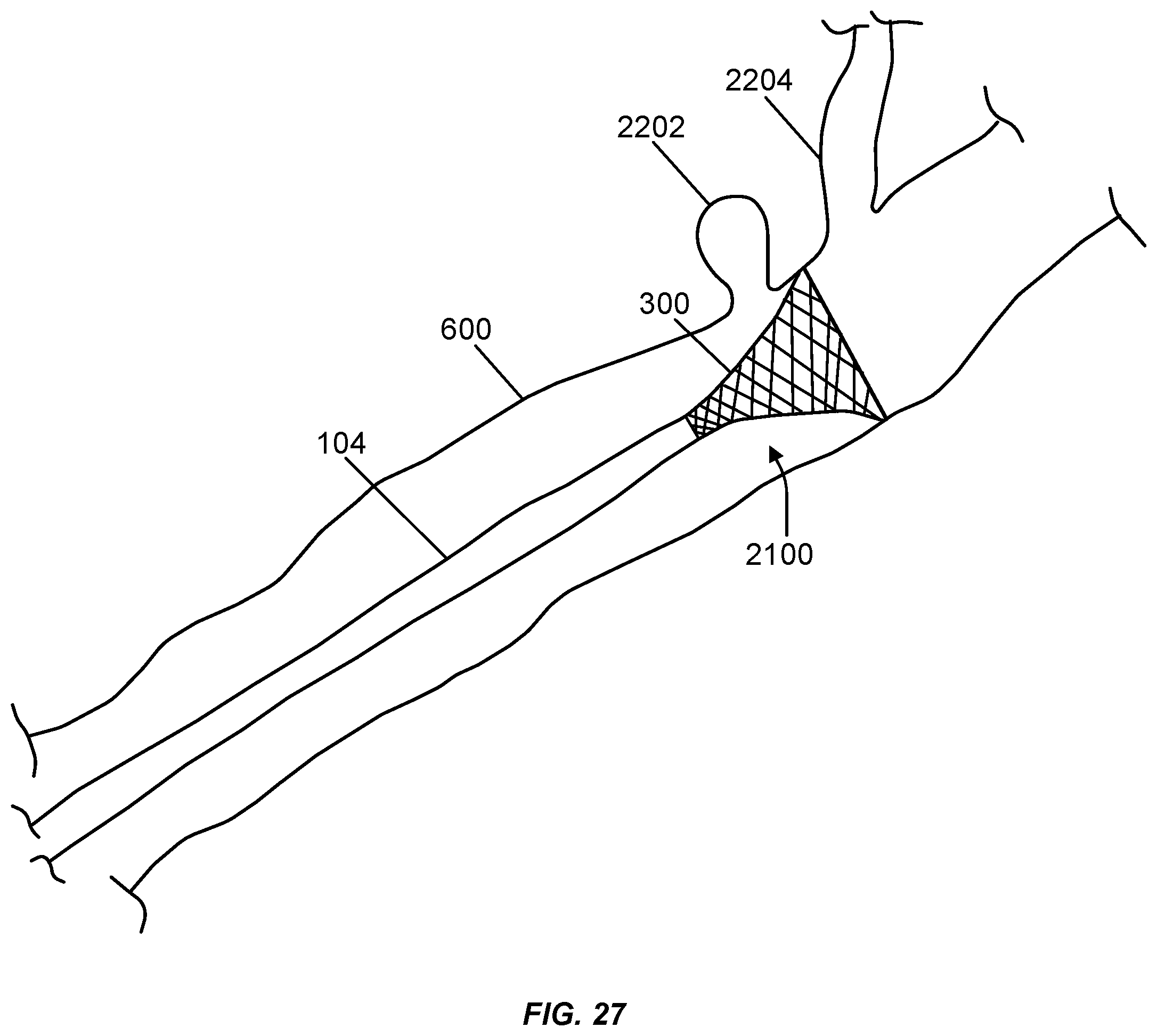 Patent US12508031 Figure 20 – Neurovascular flow diverter and delivery systems