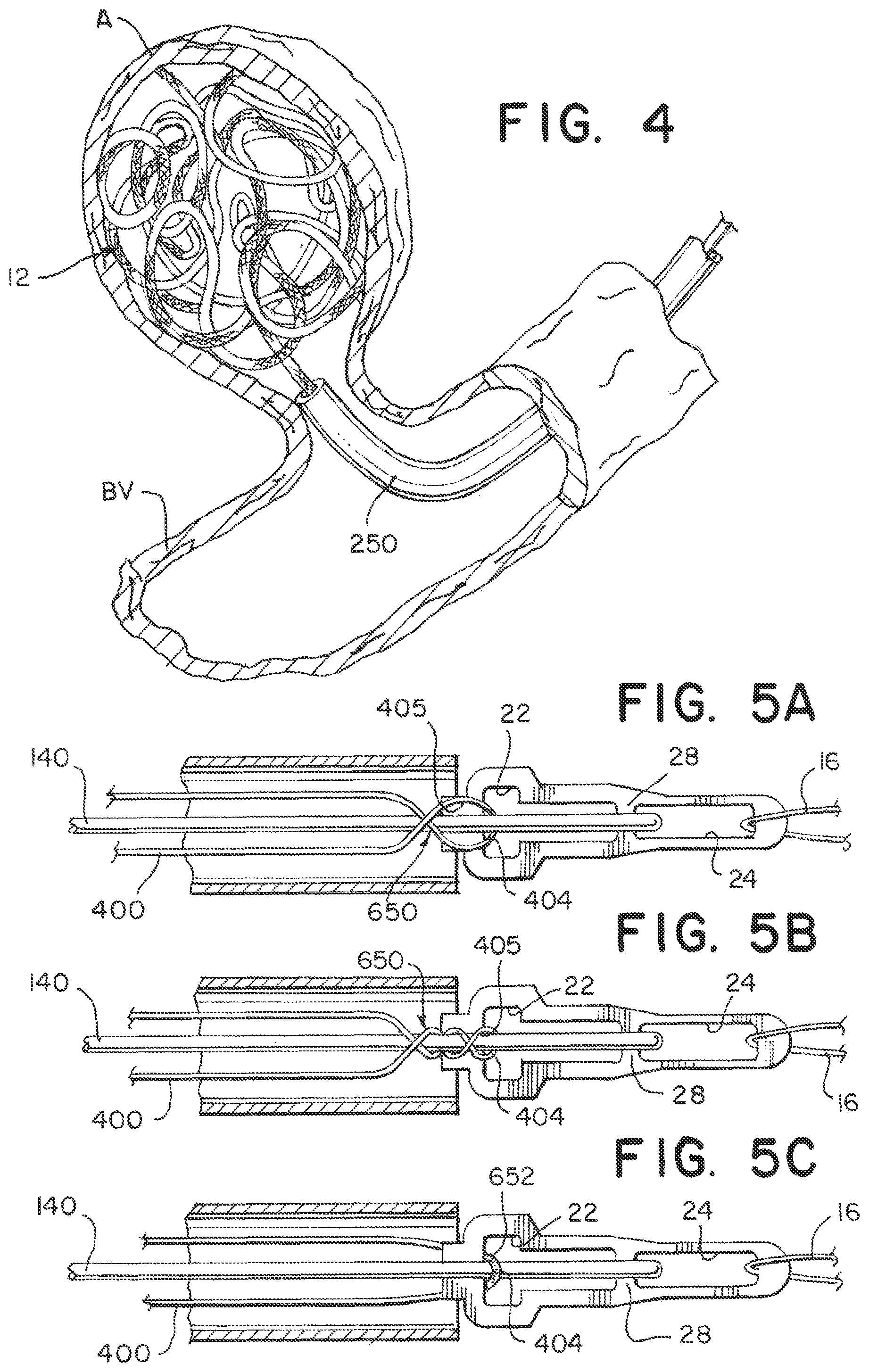 Patent US12508032 Figure 3 – Medical device delivery systems with twisting loop wires