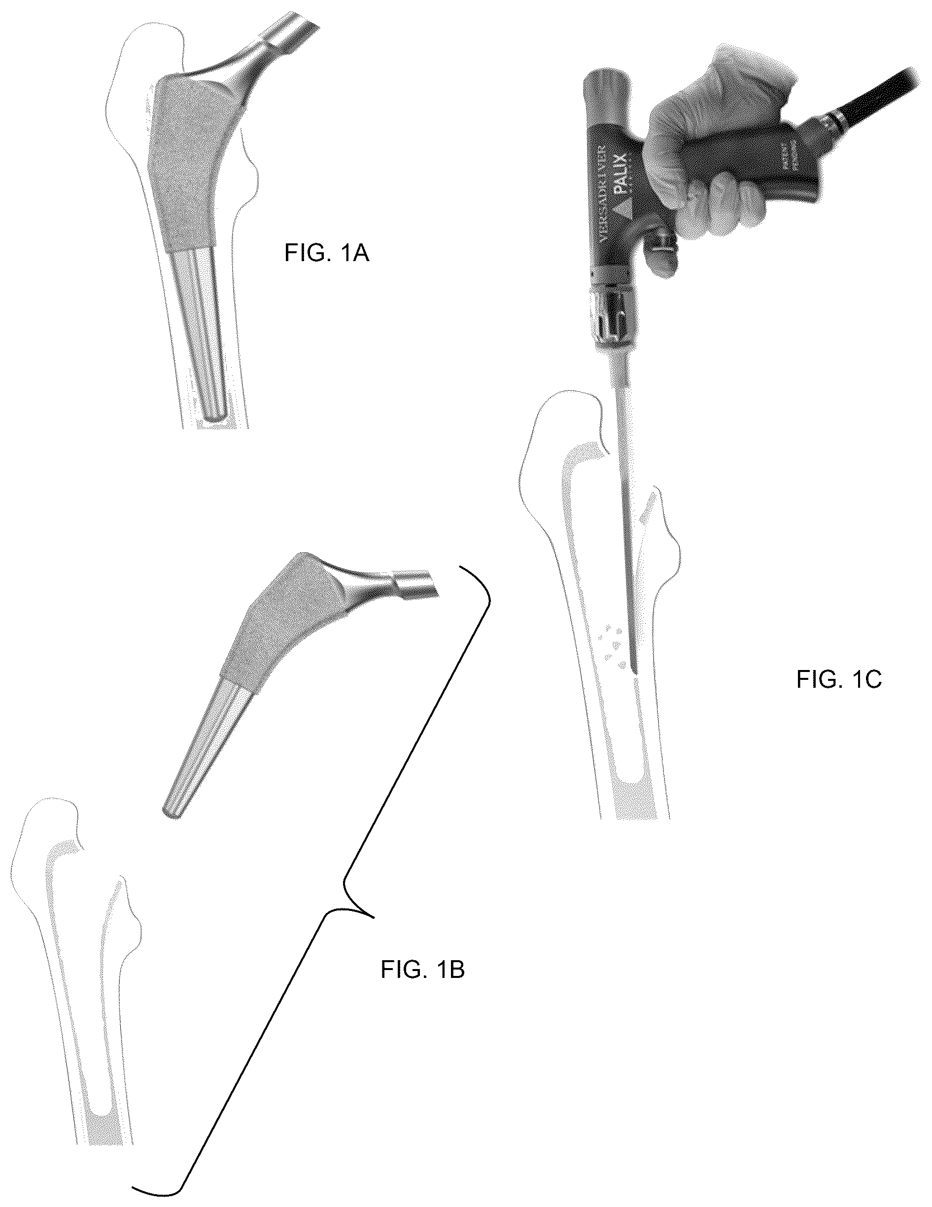 Patent US12508035 Figure 1 – Scoring blade and method for bone cement removal from intramedullary canal