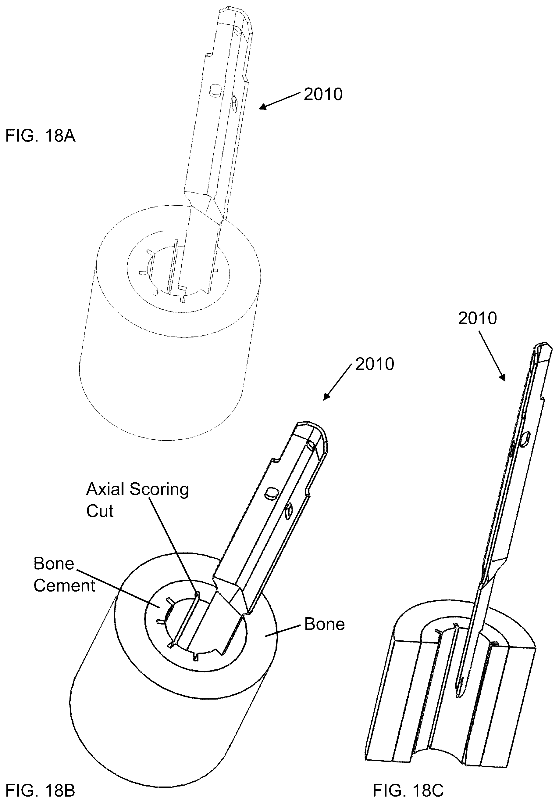 Patent US12508035 Figure 20 – Scoring blade and method for bone cement removal from intramedullary canal
