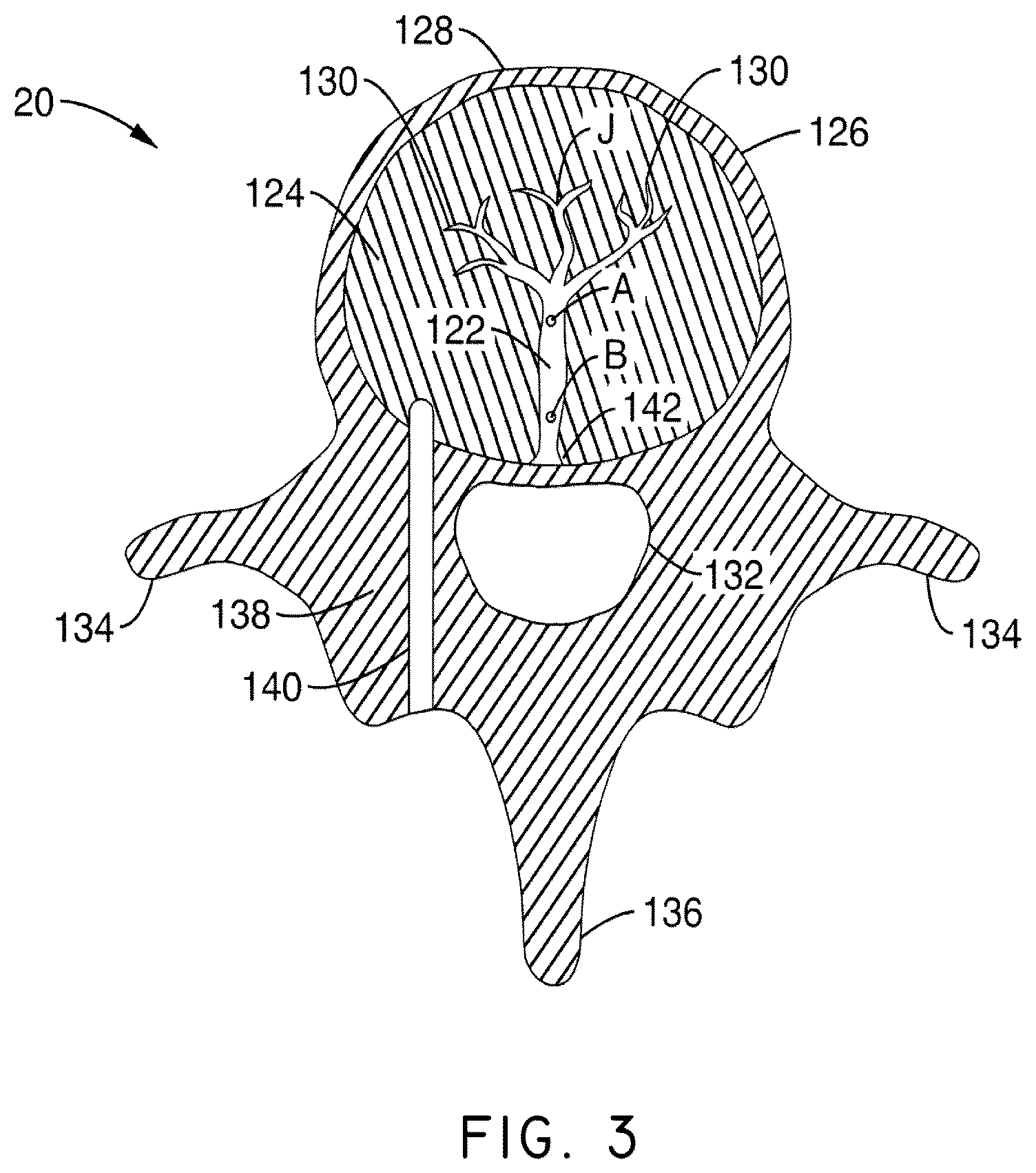 Patent US12508037 Figure 3 – Methods of navigation and treatment within a vertebral body