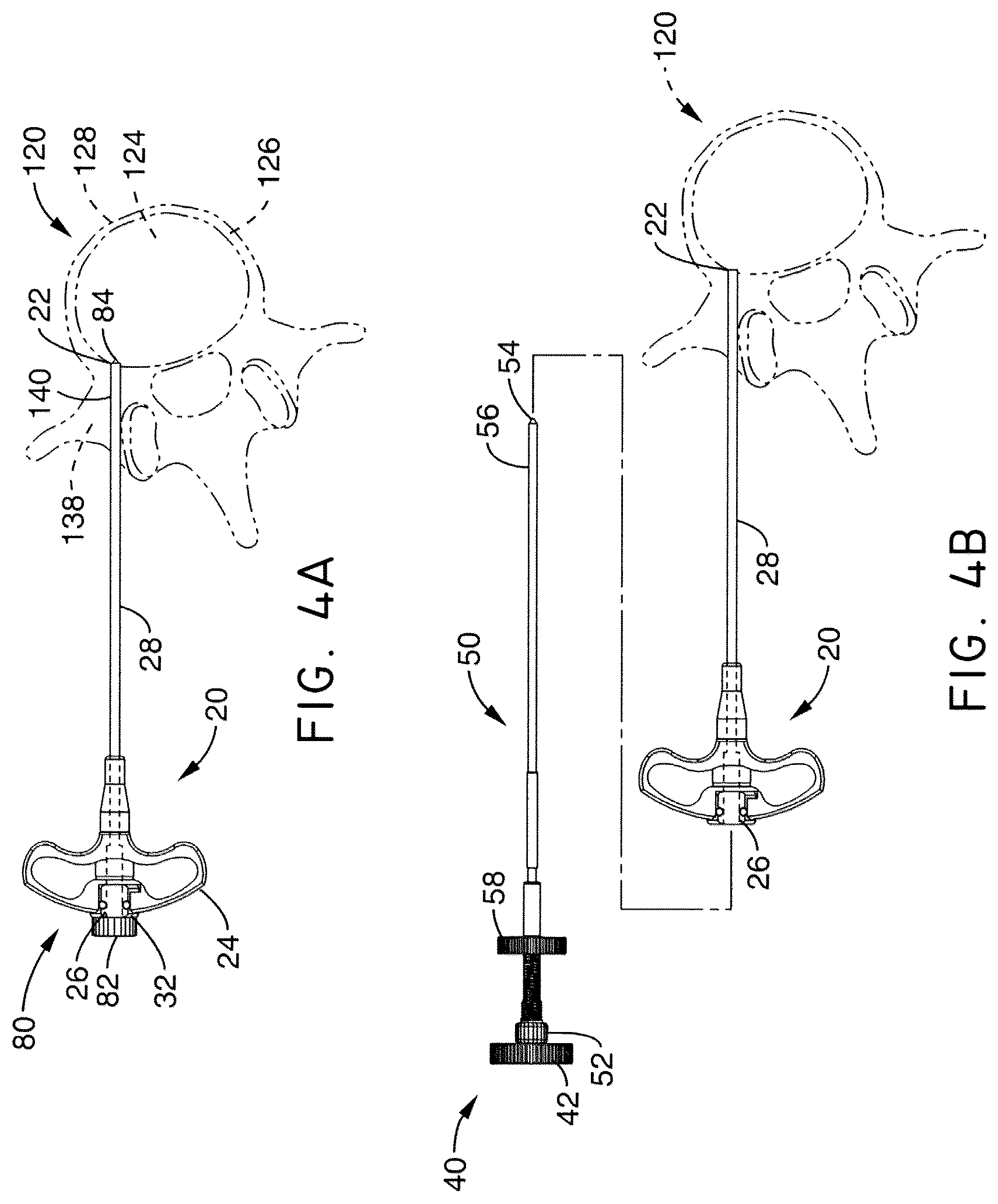 Patent US12508037 Figure 4 – Methods of navigation and treatment within a vertebral body