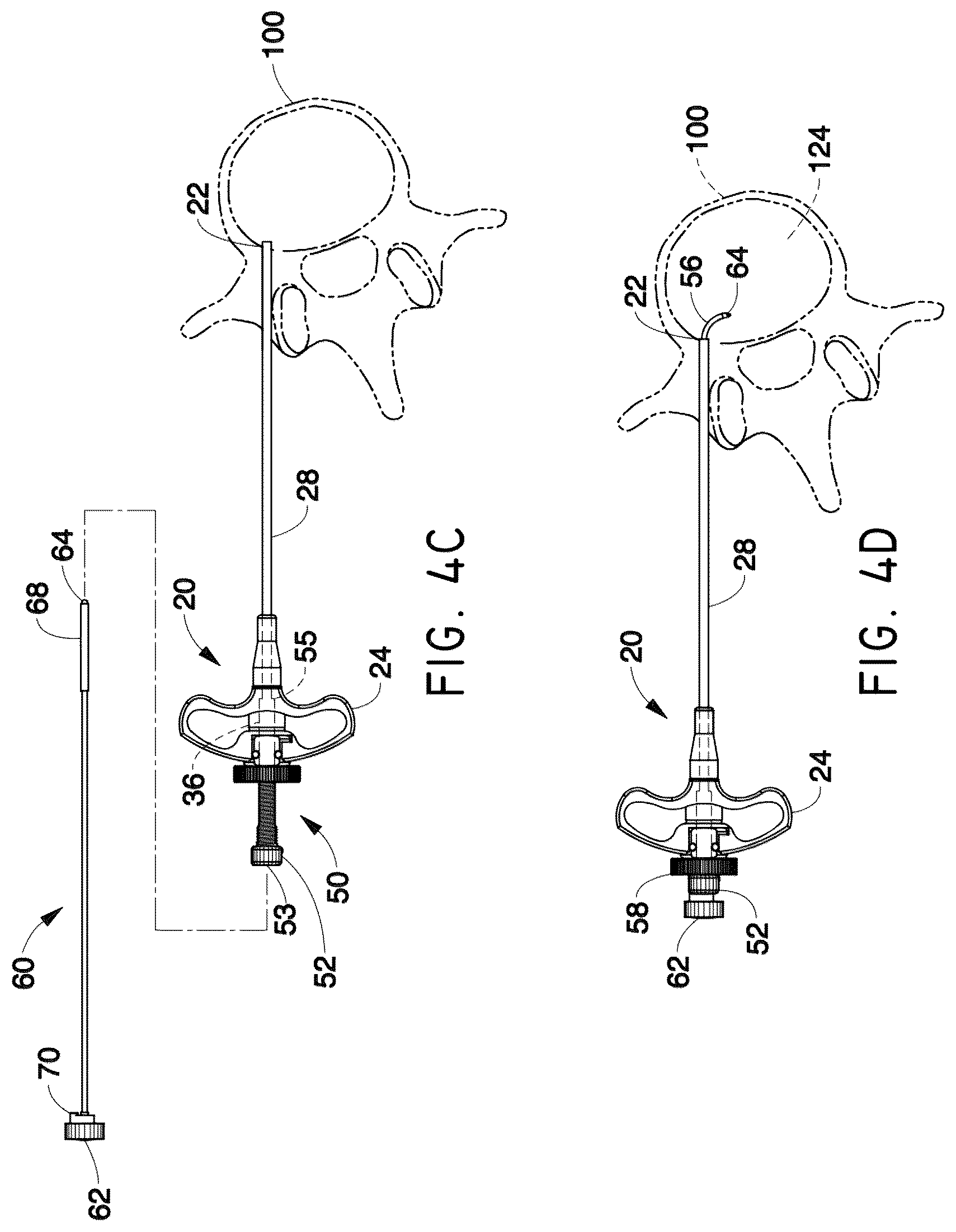 Patent US12508037 Figure 5 – Methods of navigation and treatment within a vertebral body