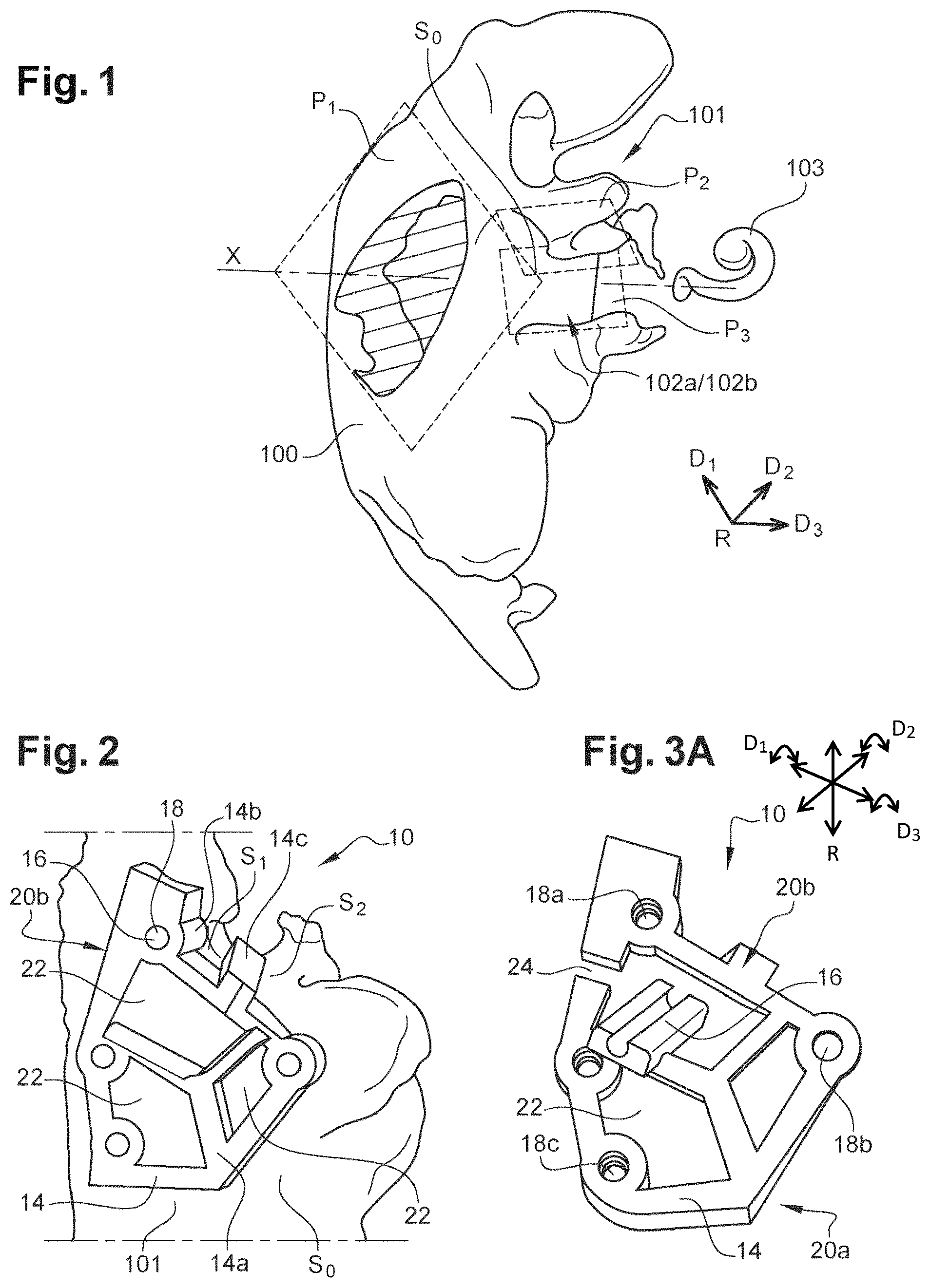 Patent US12508038 Figure 1 – Surgical insertion guide