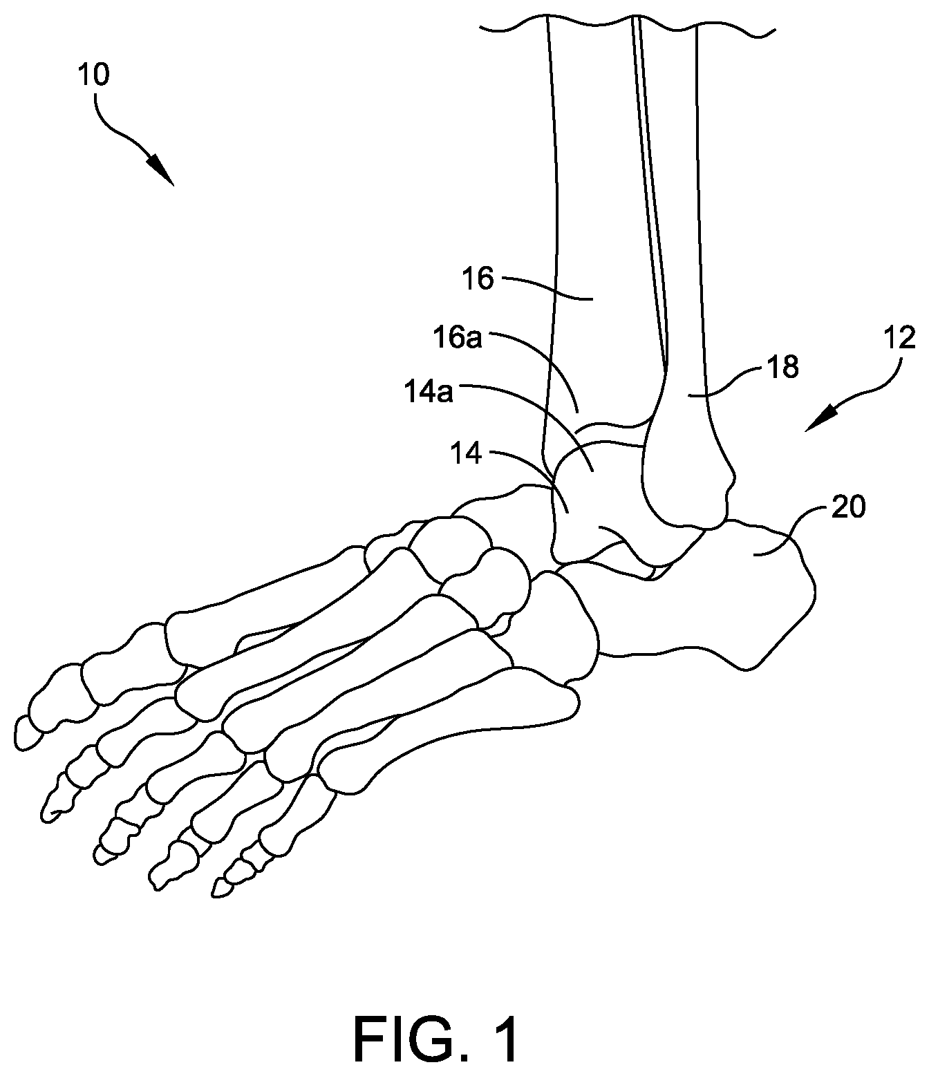 Patent US12508039 Figure 1 – Orthopedic surgical guide