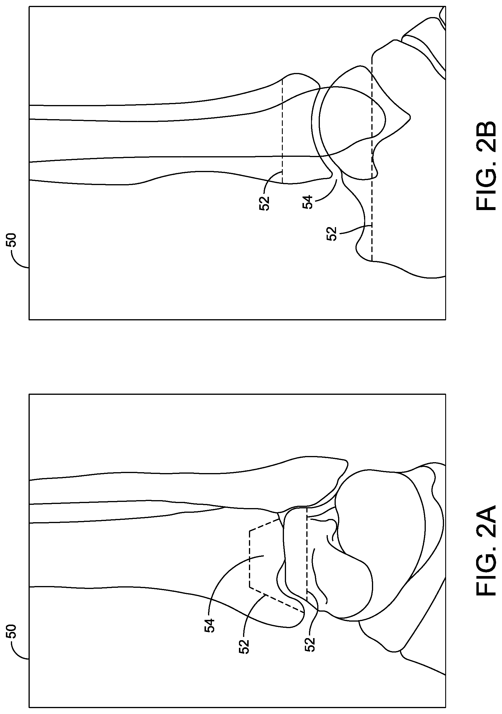 Patent US12508039 Figure 2 – Orthopedic surgical guide