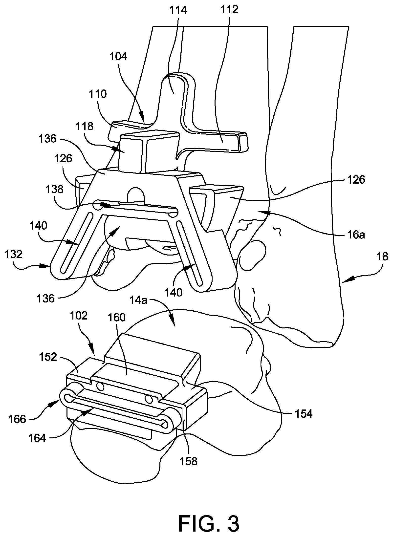 Patent US12508039 Figure 3 – Orthopedic surgical guide