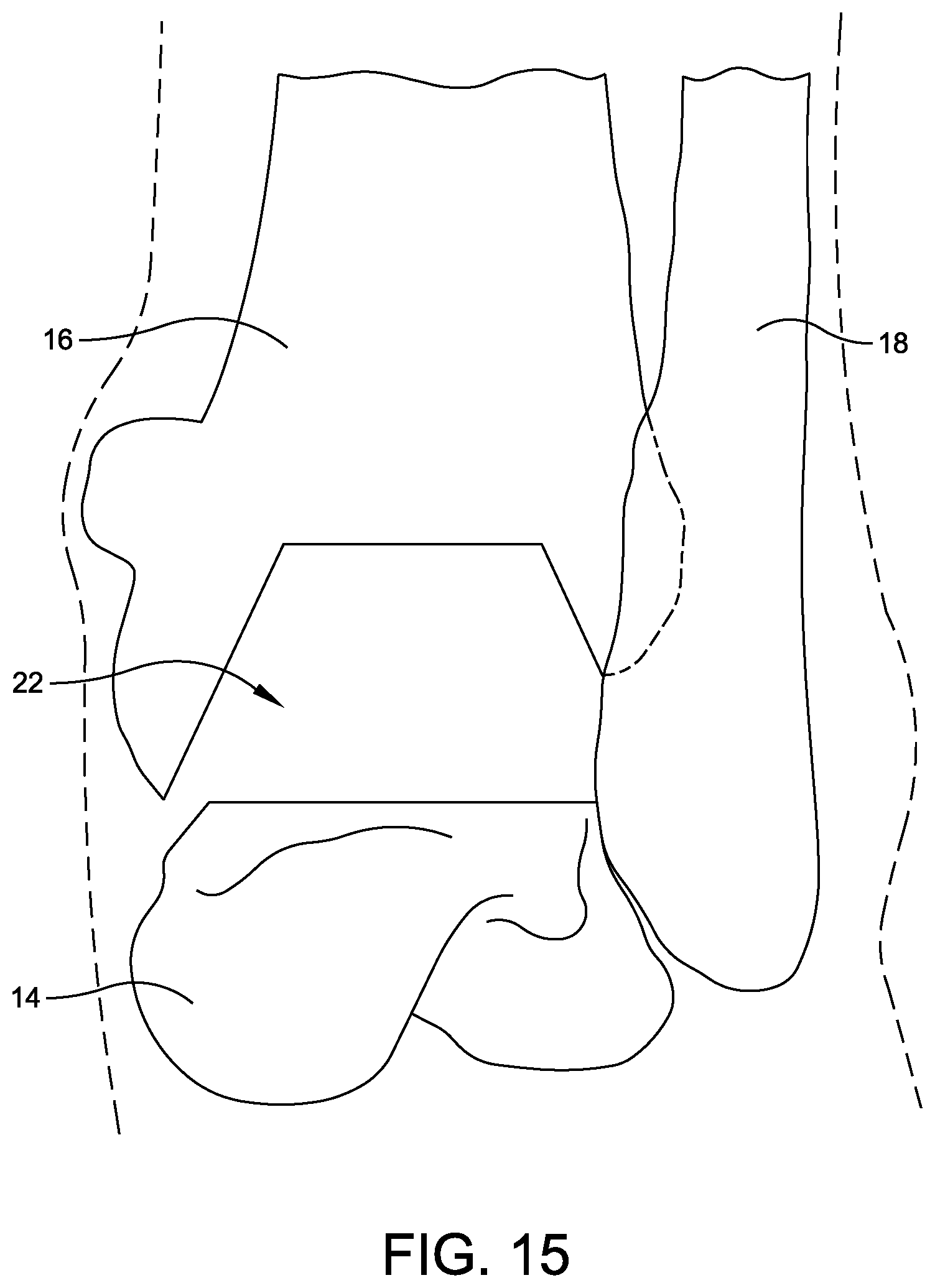 Patent US12508039 Figure 13 – Orthopedic surgical guide