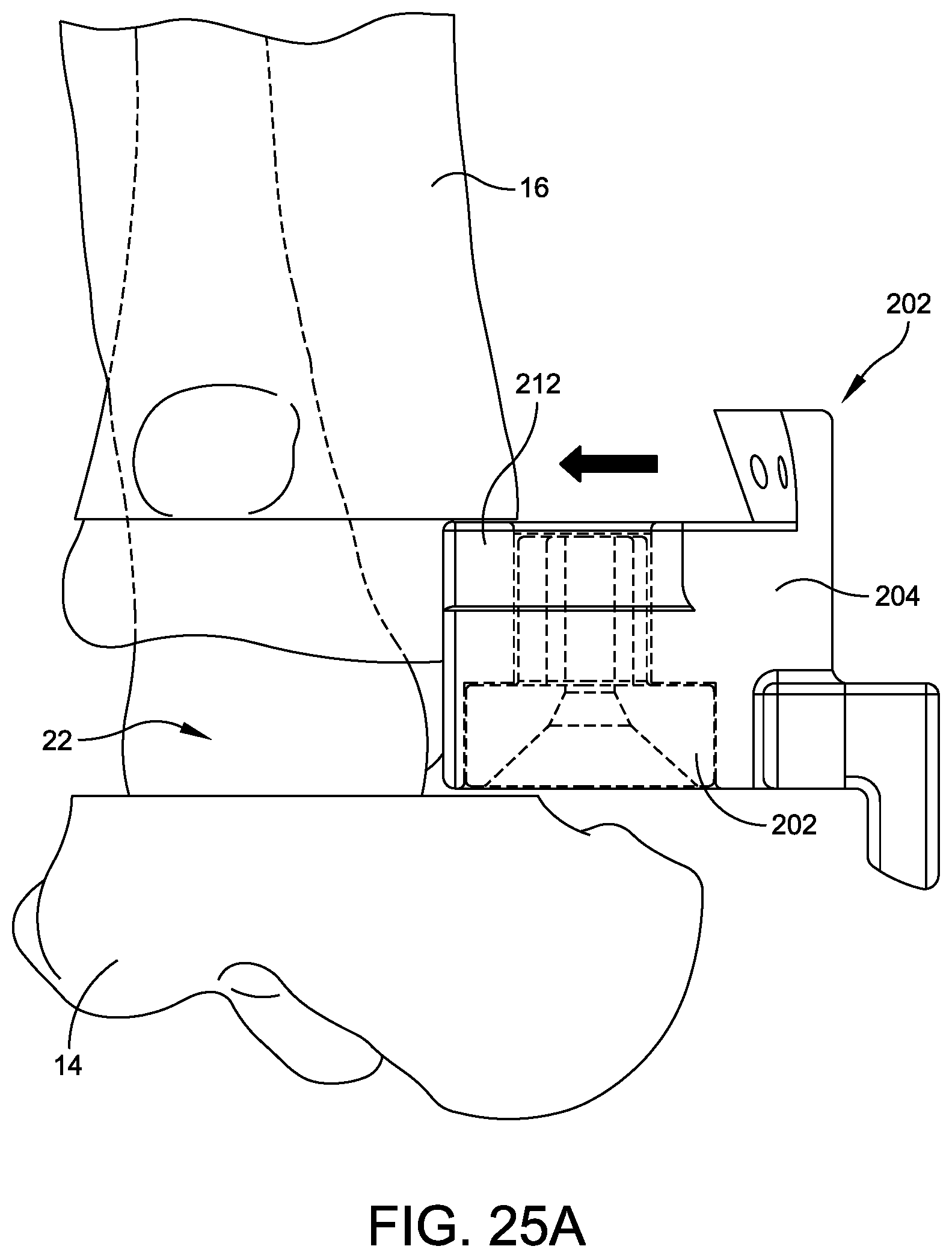 Patent US12508039 Figure 19 – Orthopedic surgical guide
