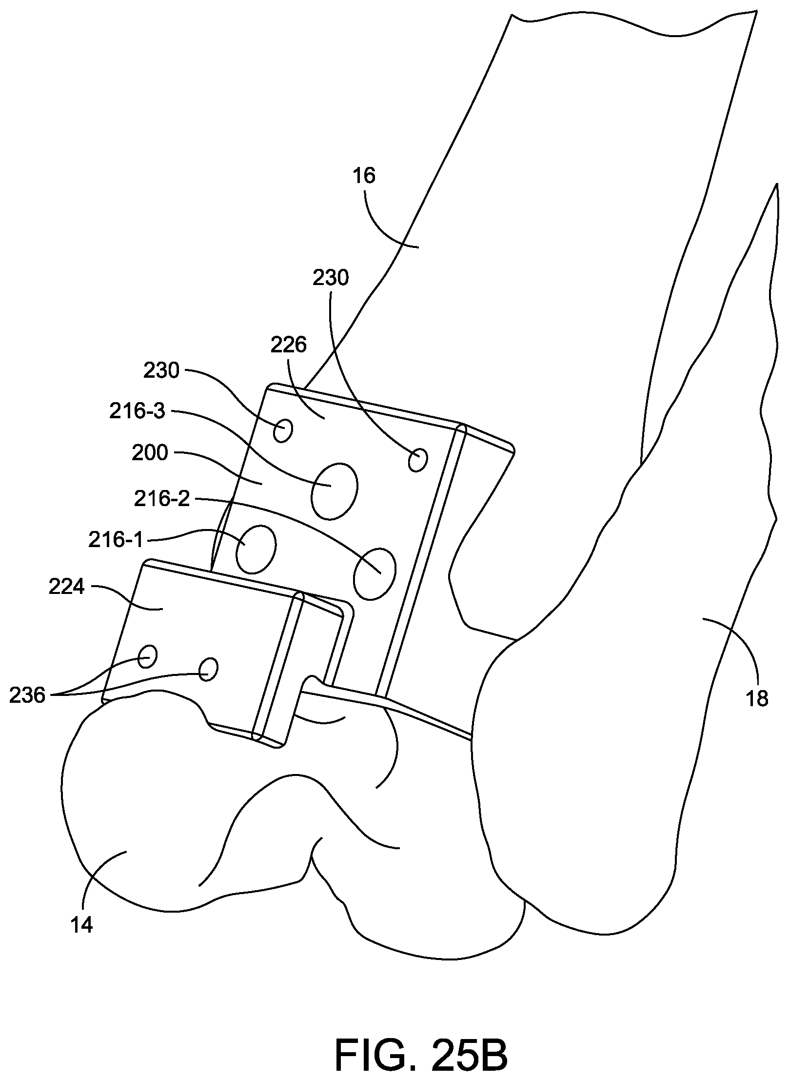 Patent US12508039 Figure 20 – Orthopedic surgical guide