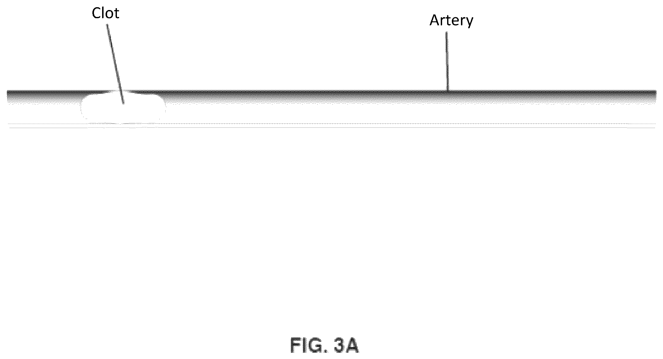 Patent US12508042 Figure 5 – Retrieval system