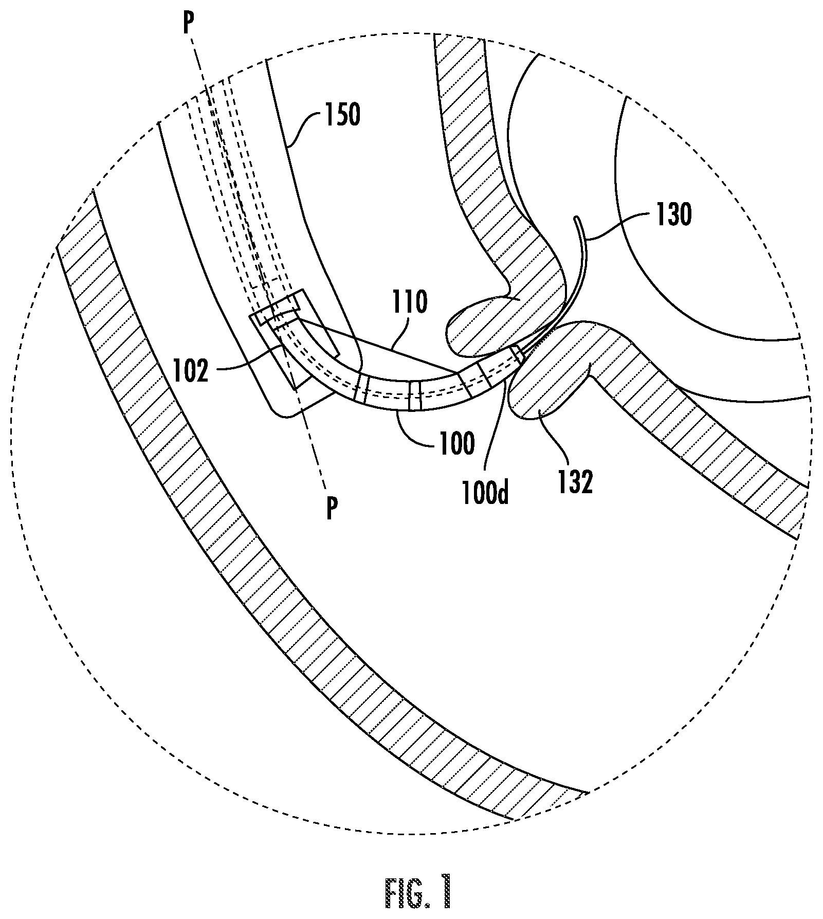 Patent US12508047 — Devices, systems, and methods for accessing a body lumen — Figure 1