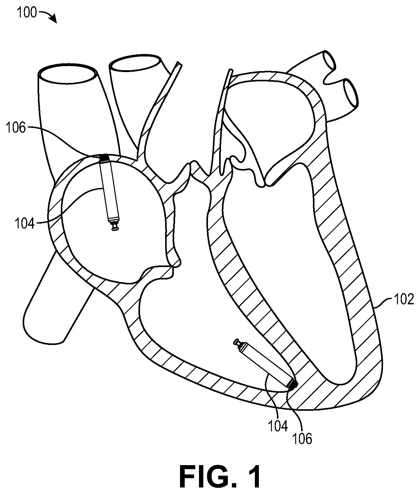 Patent US12508052 Figure 1 – Implant delivery and retrieval systems and methods