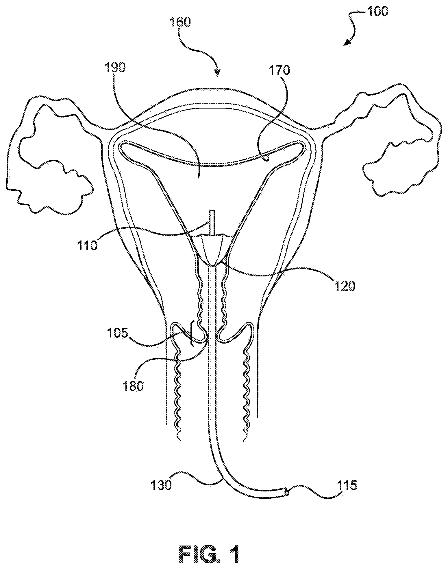 Patent US12508053 Figure 1 – Systems, devices, and methods for uterine hemostasis
