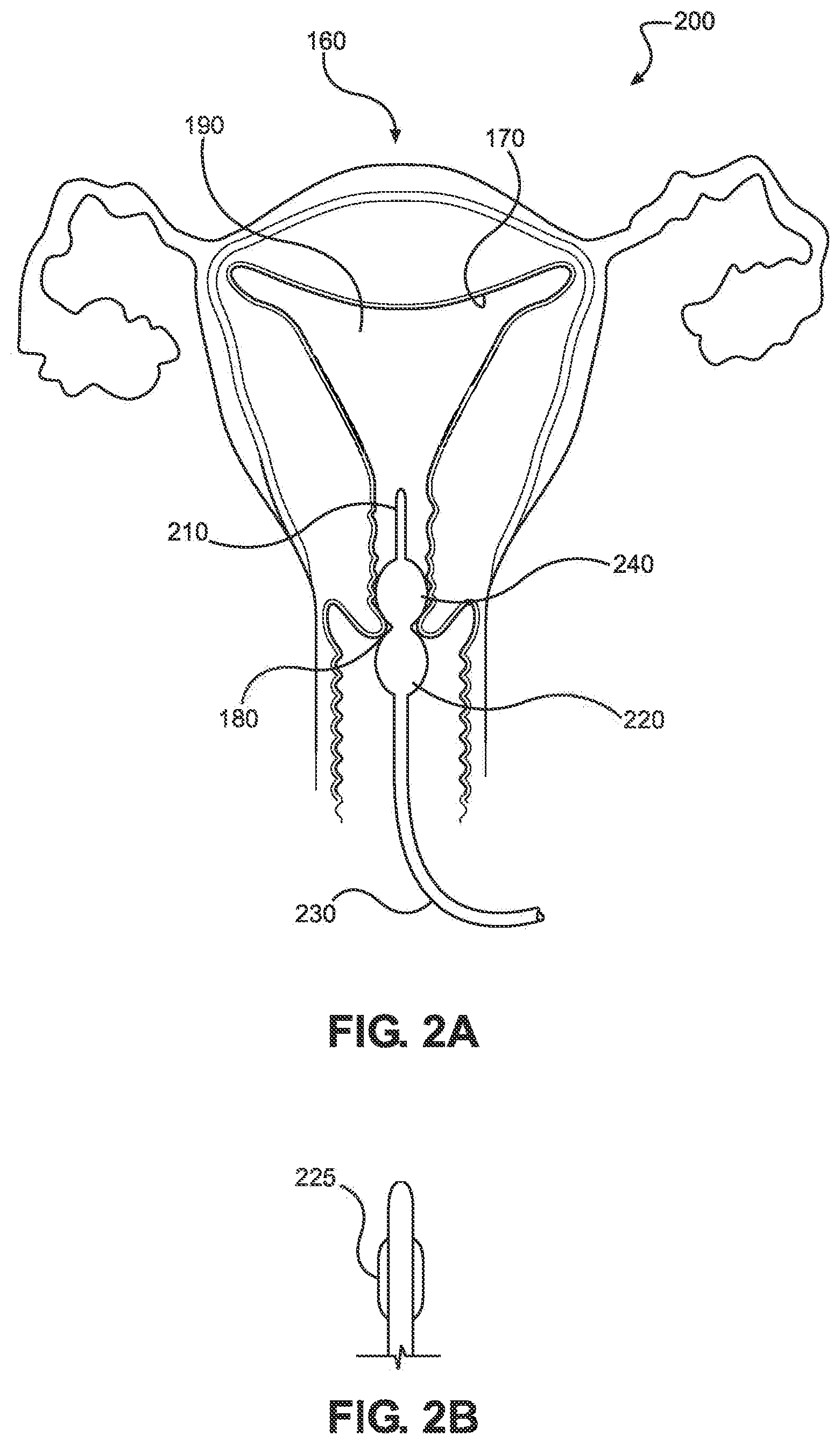 Patent US12508053 Figure 2 – Systems, devices, and methods for uterine hemostasis