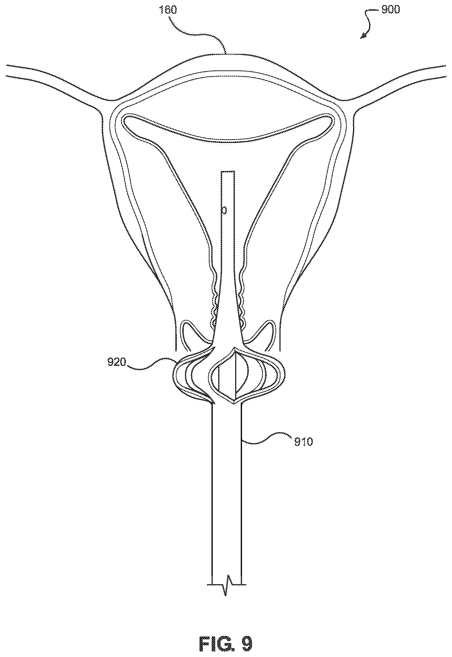 Patent US12508053 Figure 9 – Systems, devices, and methods for uterine hemostasis