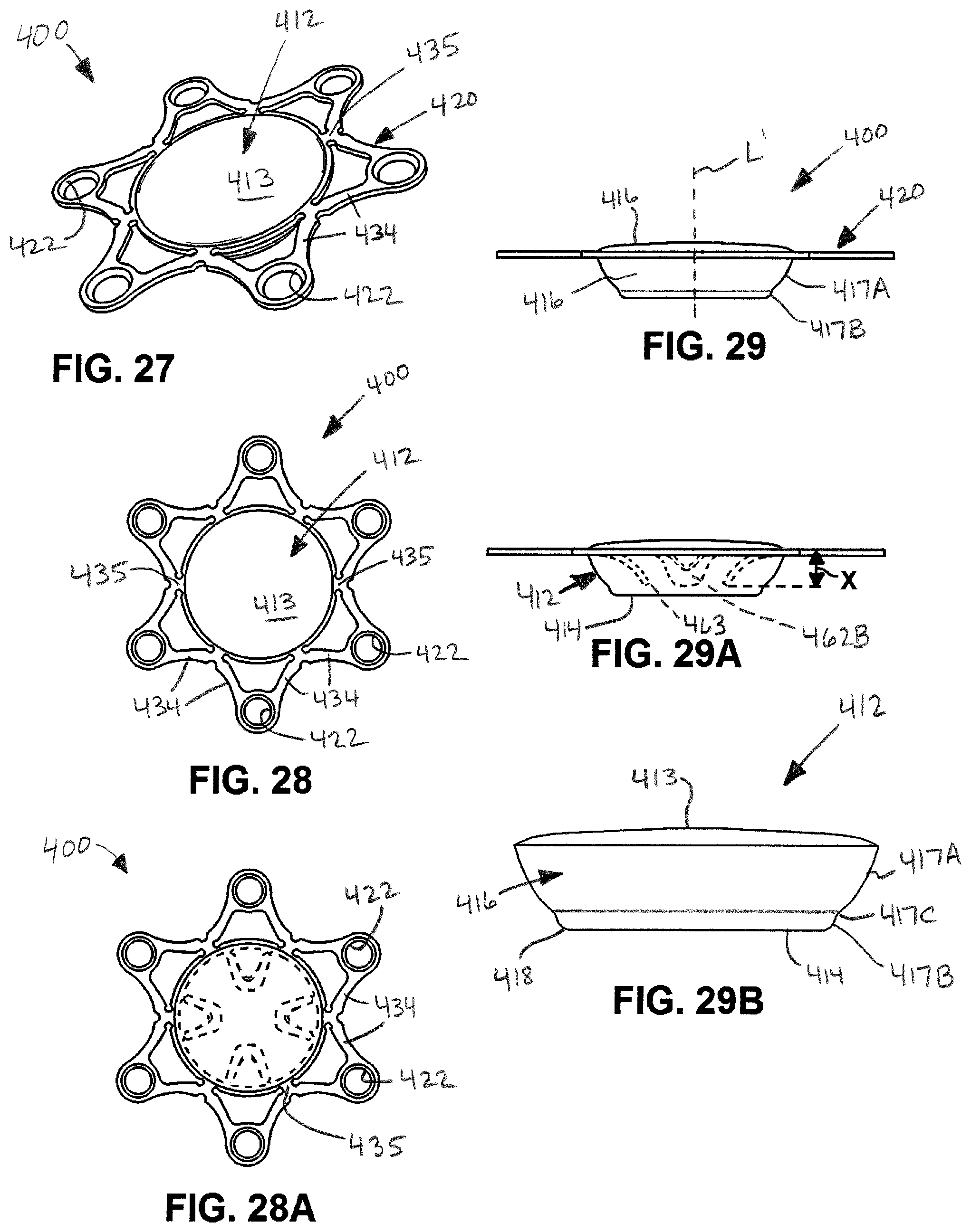 Patent US12508054 Figure 11 – Implants for filling bore holes in bone and methods for filling bore holes in bone