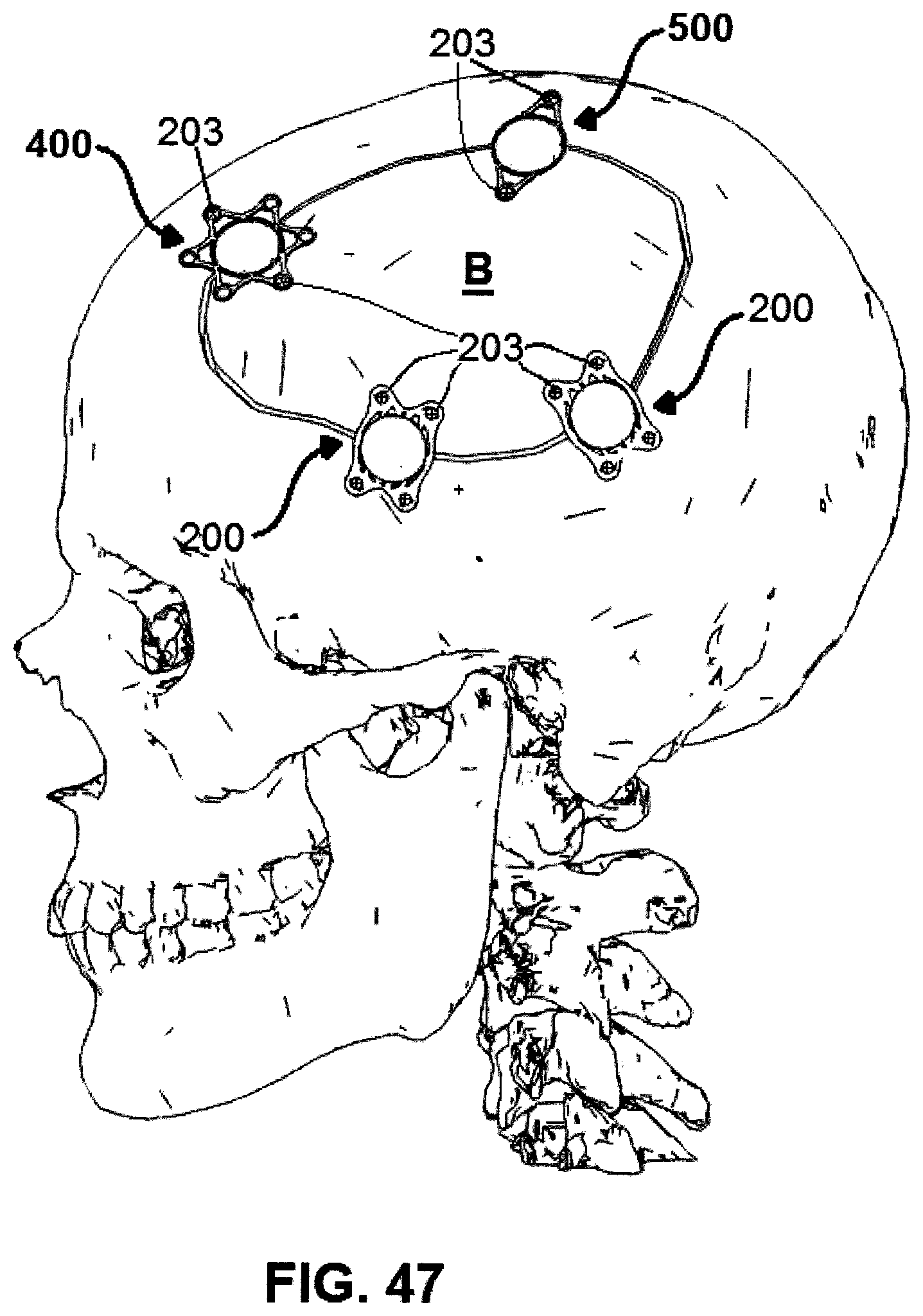 Patent US12508054 Figure 17 – Implants for filling bore holes in bone and methods for filling bore holes in bone
