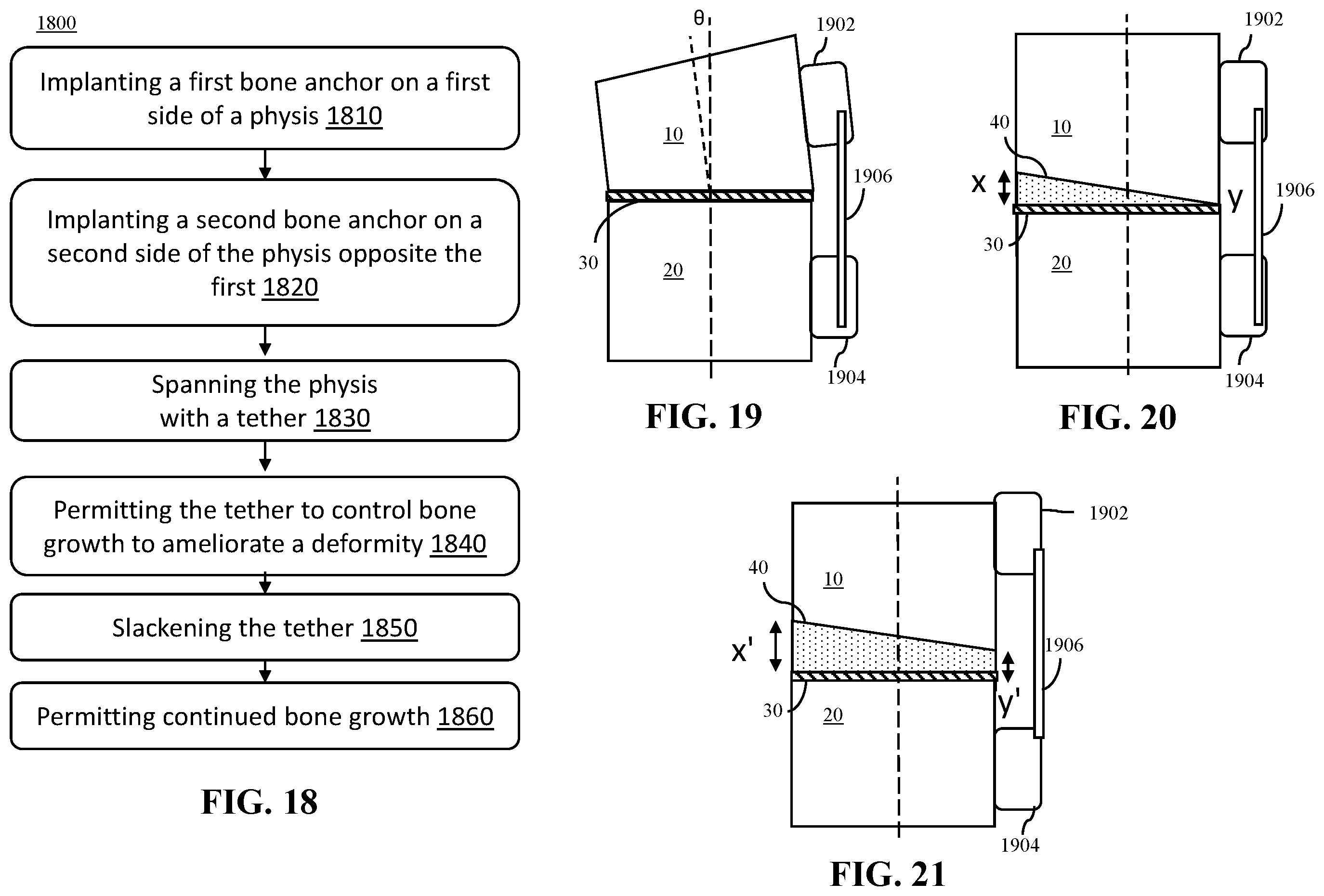 Patent US12508058 Figure 15 – Adjustable tether implant