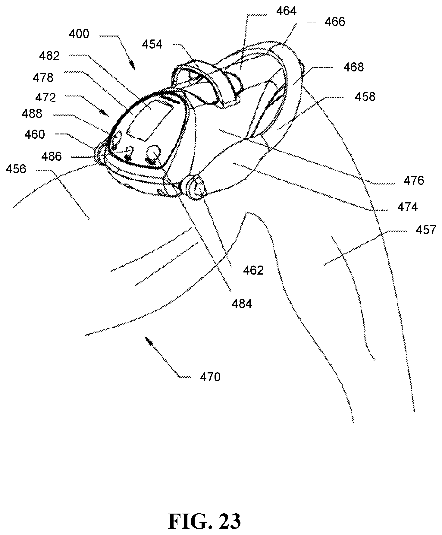 Patent US12508058 Figure 17 – Adjustable tether implant