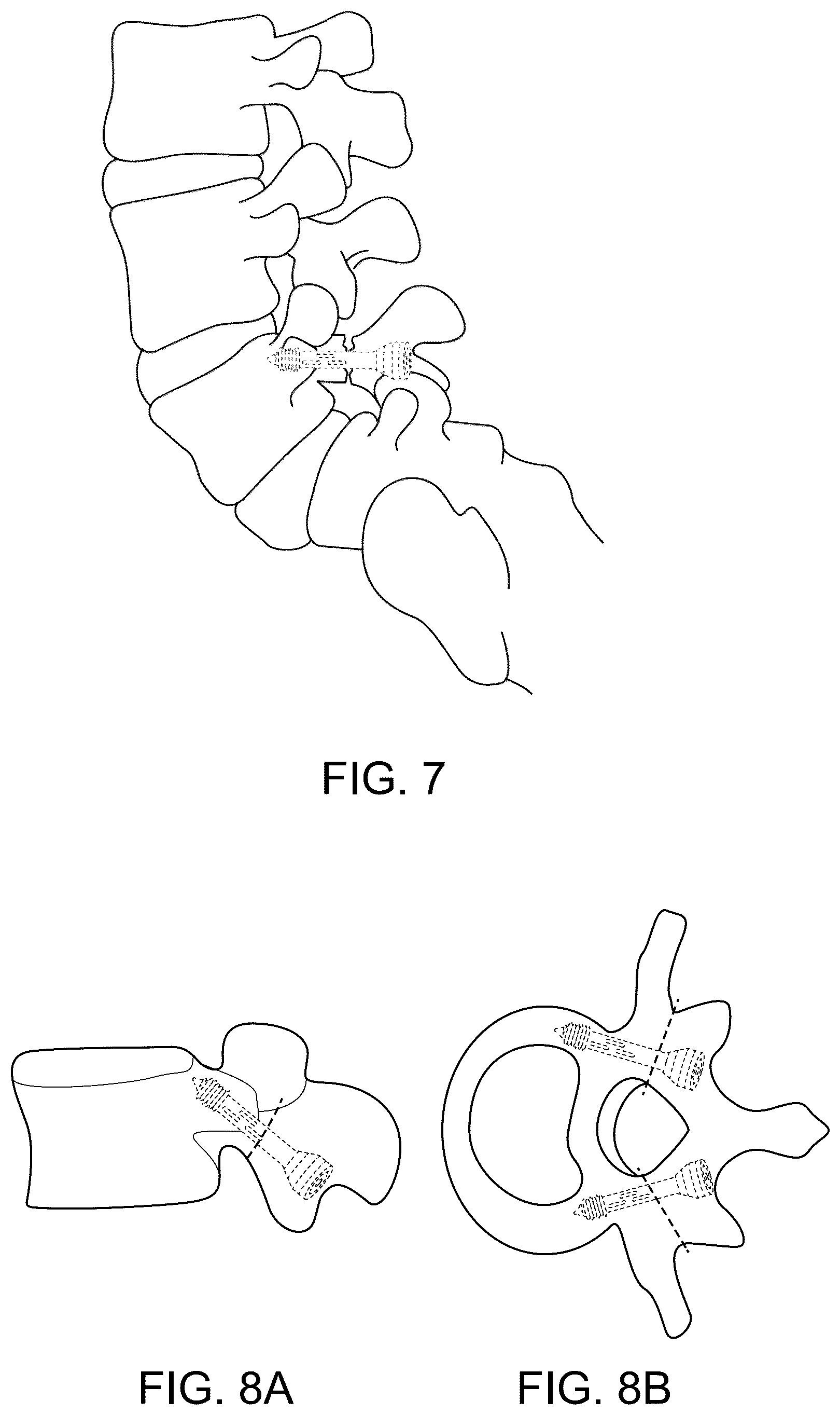 Patent US12508059 Figure 7 – Orthopedic screw and screw fastening device for orthopedic operations