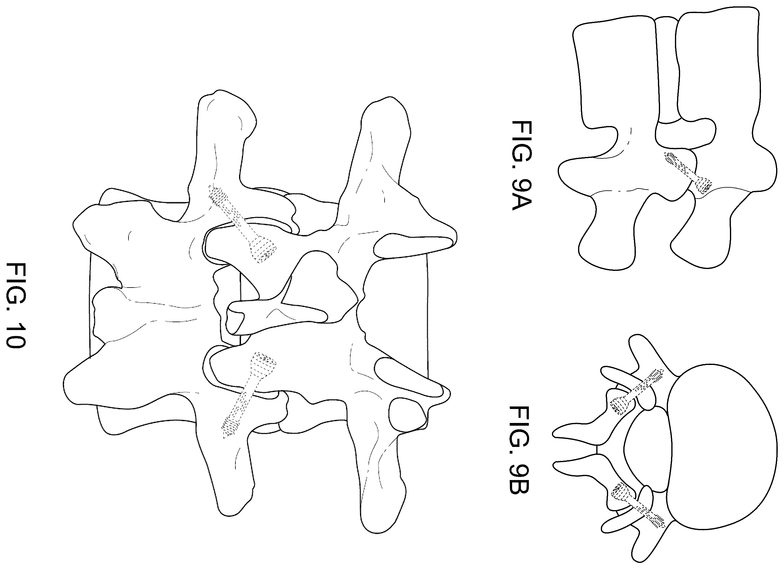 Patent US12508059 Figure 8 – Orthopedic screw and screw fastening device for orthopedic operations