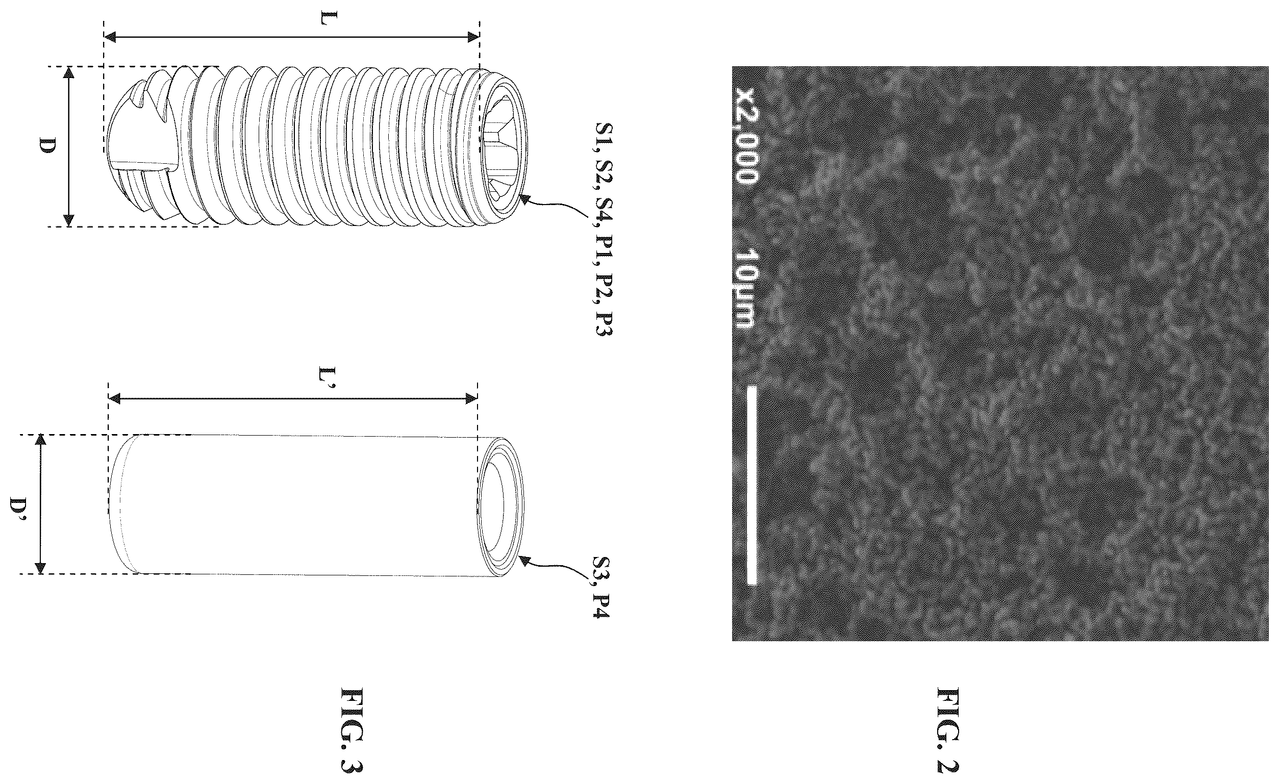 Patent US12508060 Figure 2 – Bone-anchored implant, and method for manufacturing such an implant