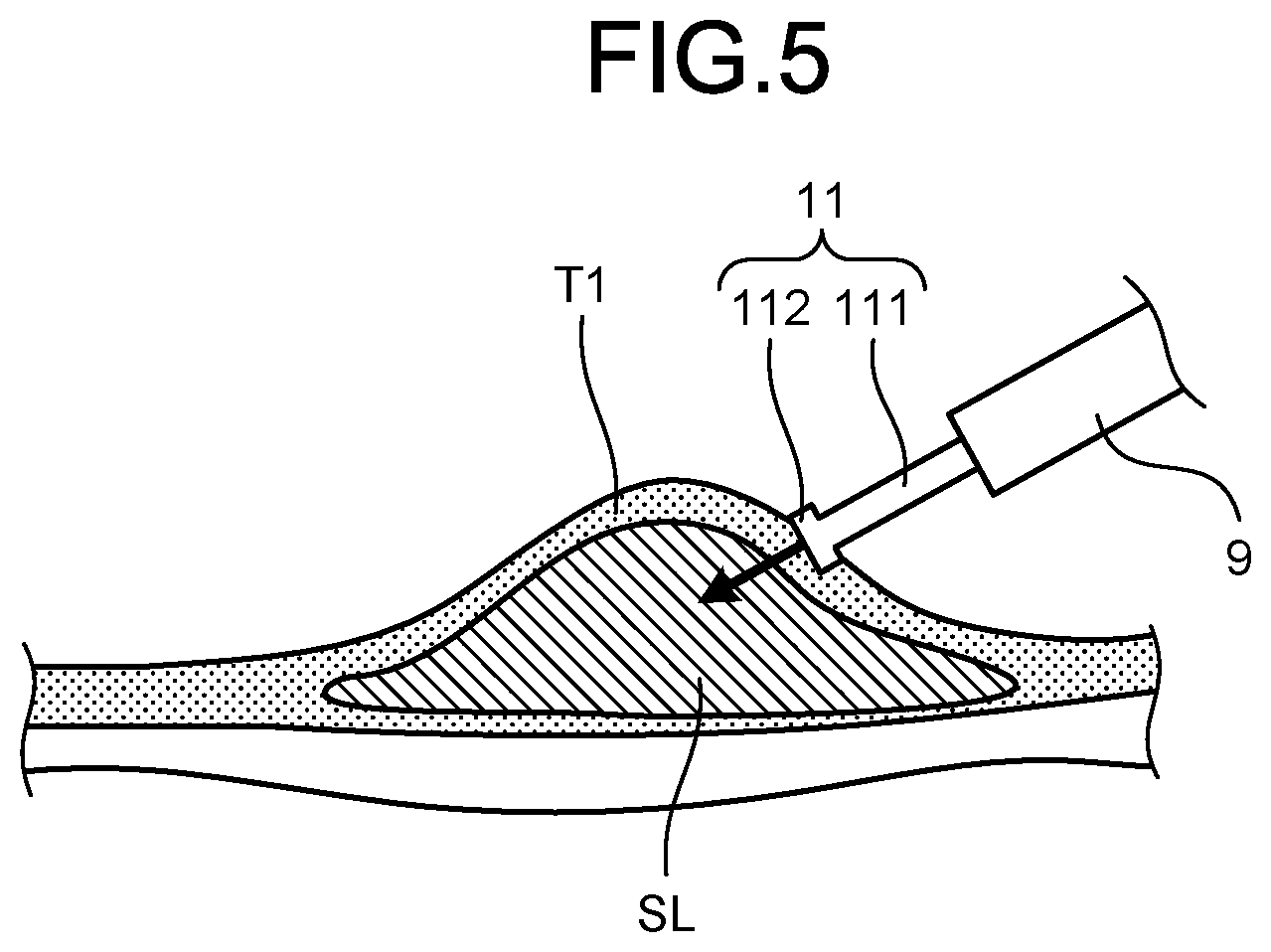 Patent US12508070 Figure 5 – Endoscope treatment tool
