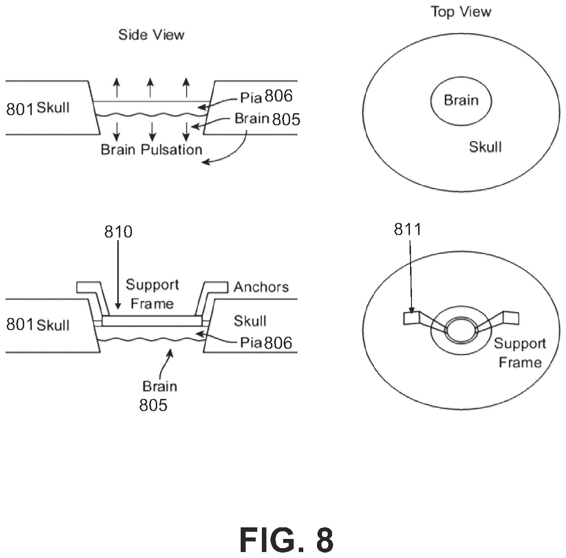 Patent US12508073 Figure 10 – Systems, devices, and methods for tissue layer removal